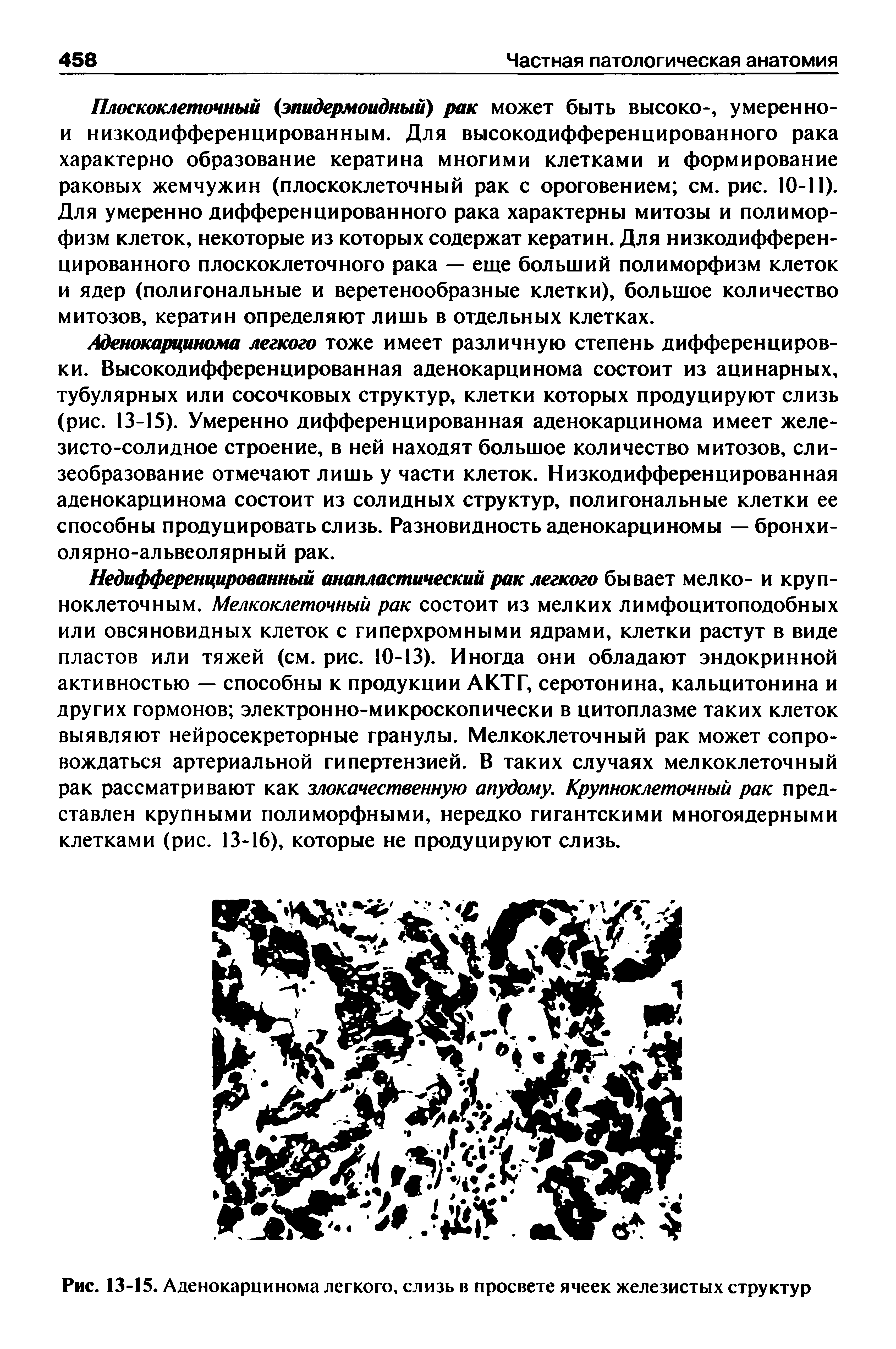 Рис. 13-15. Аденокарцинома легкого, слизь в просвете ячеек железистых структур...