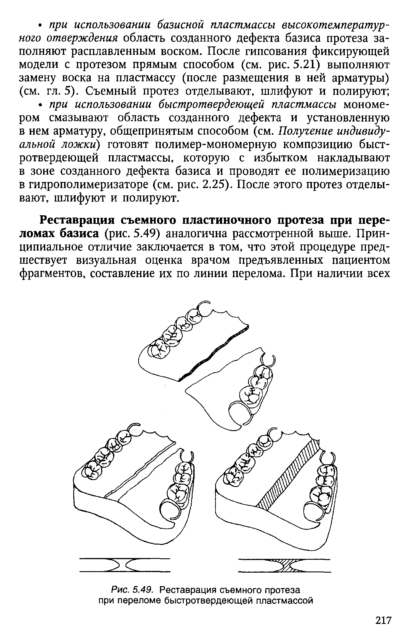 Рис. 5.49. Реставрация съемного протеза при переломе быстротвердеющей пластмассой...