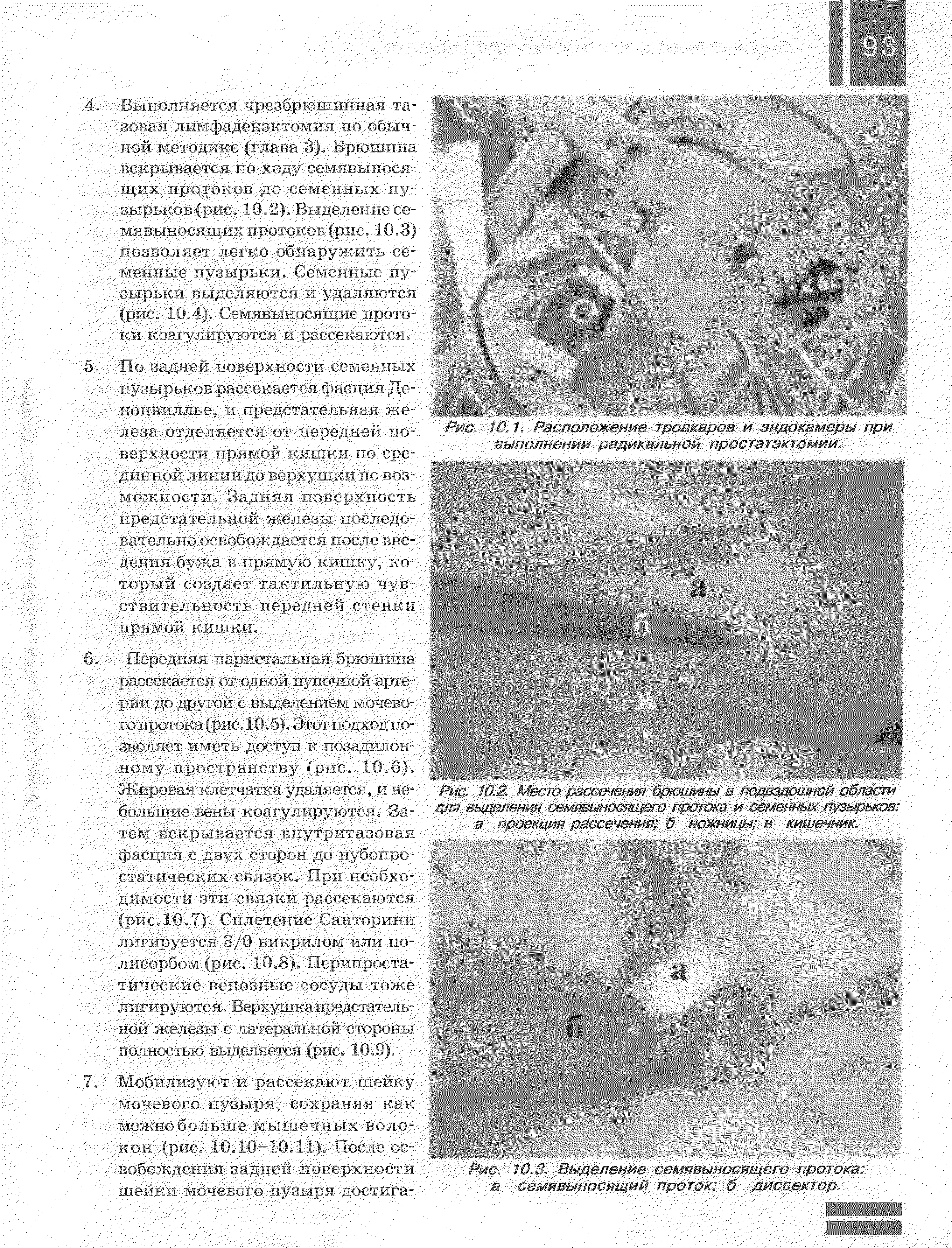 Рис. 10.3. Выделение семявыносящего протока, а семявыносящий проток б диссектор.