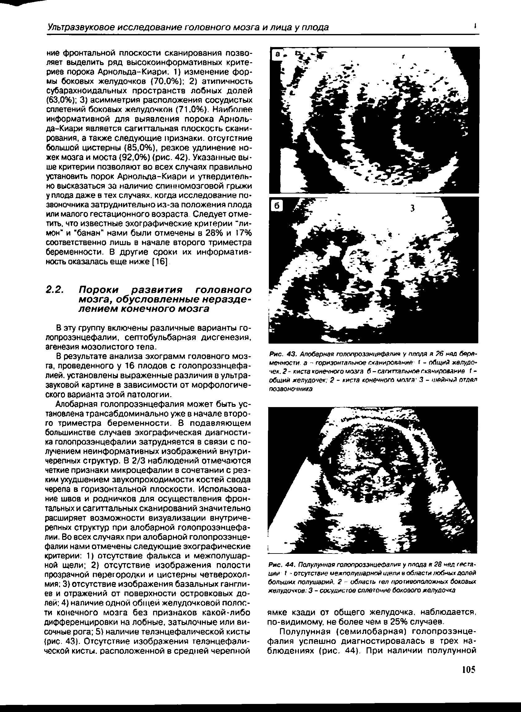 Рис. 44. Полулунная го/юпроззнцеФапия у плода я 28 над теста-иии - отсутствие межполушарнойщели к области лобных долей больших полушарий. 2 - область тел противоположных боковых желудочков. 3 - сосудистое сплетение бокового желудочка...