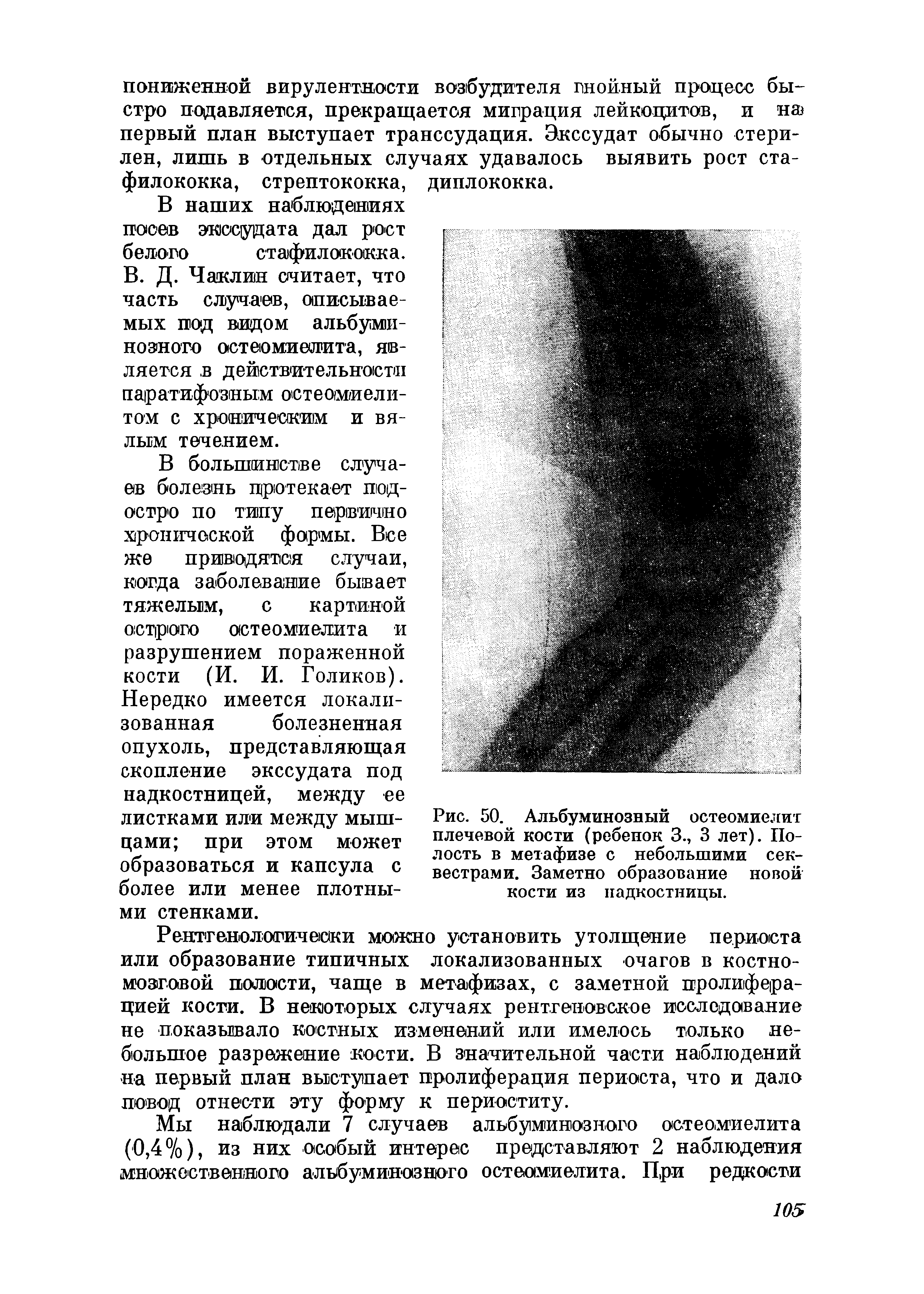 Рис. 50. Альбуминозный остеомиелит плечевой кости (ребенок 3., 3 лет). Полость в метафизе с небольшими секвестрами. Заметно образование новой кости из надкостницы.