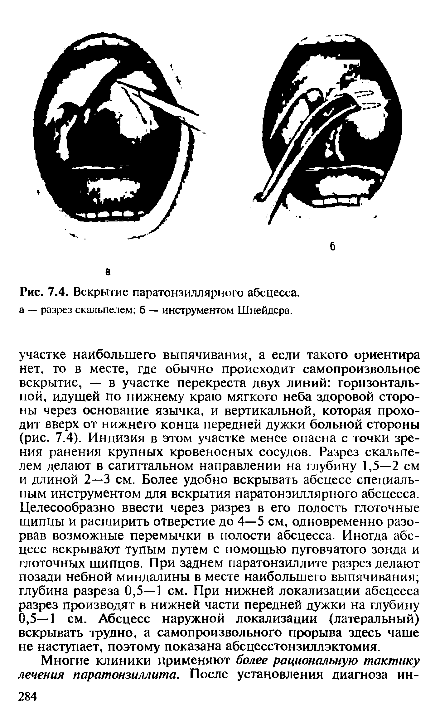 Рис. 7.4. Вскрытие паратонзиллярного абсцесса, а — разрез скальпелем б — инструментом Шнейдера.