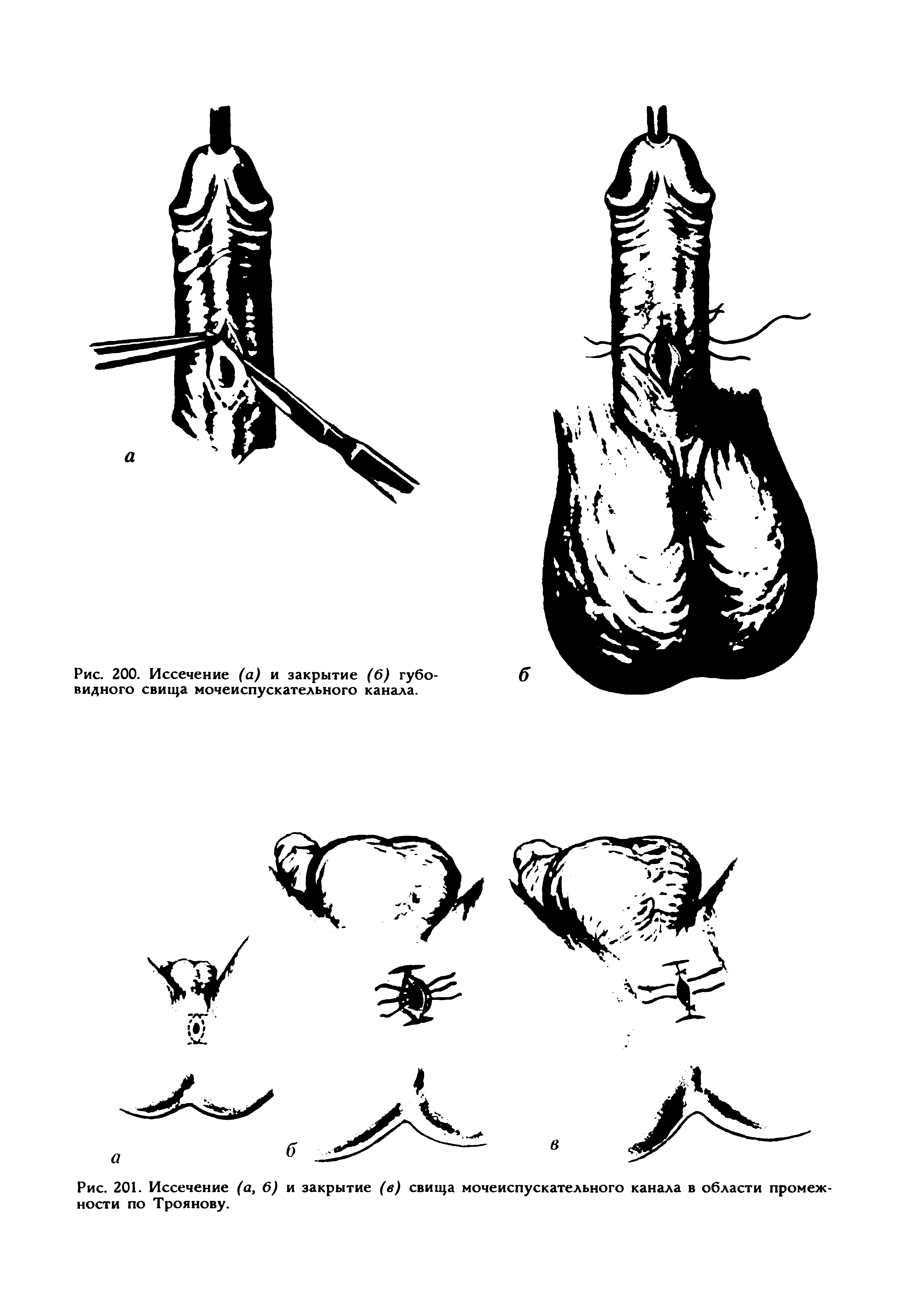 Рис. 201. Иссечение (а, 6) и закрытие (в) свища мочеиспускательного канала в области промежности по Троянову.