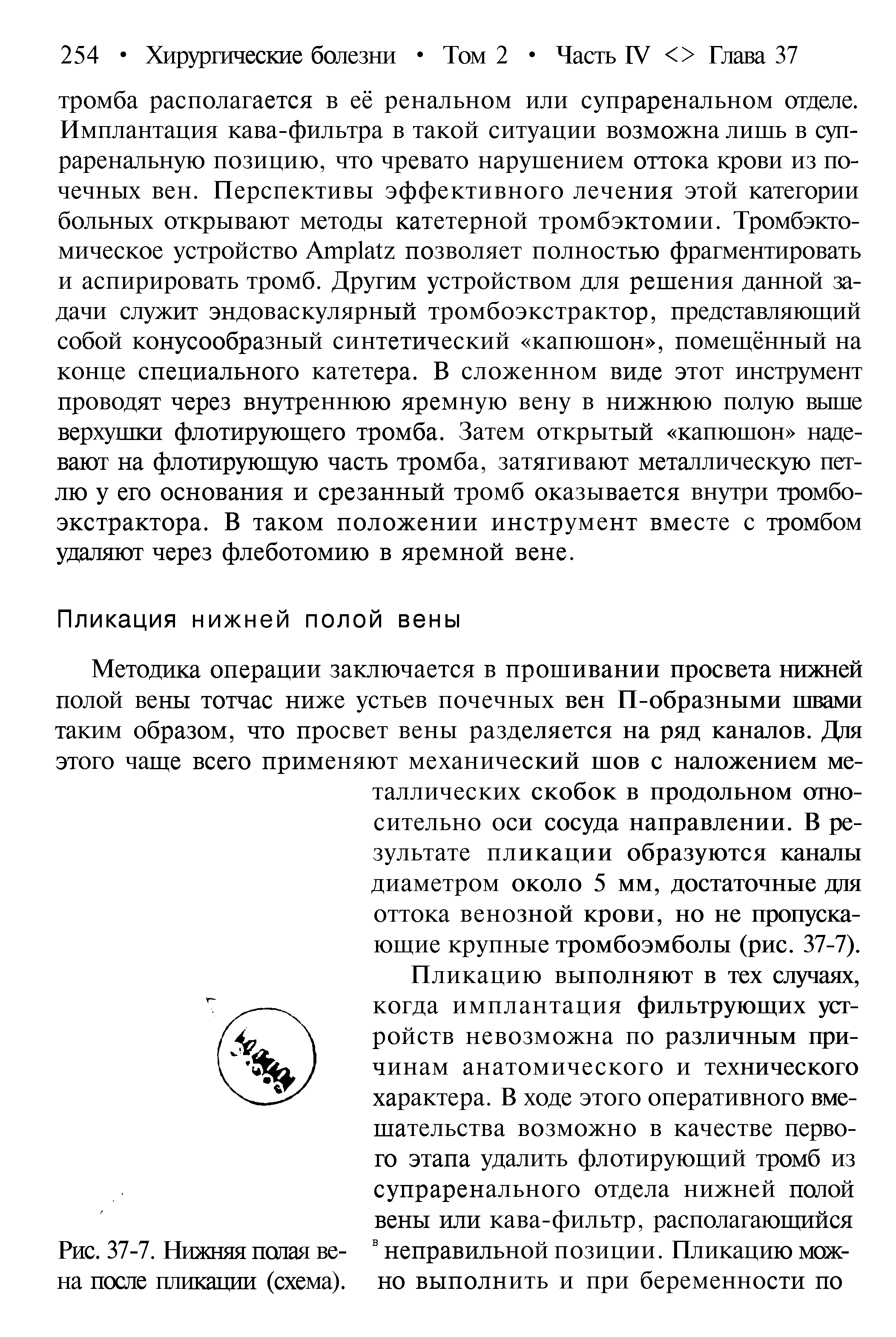 Рис. 37-7. Нижняя полая вена после пликации (схема).