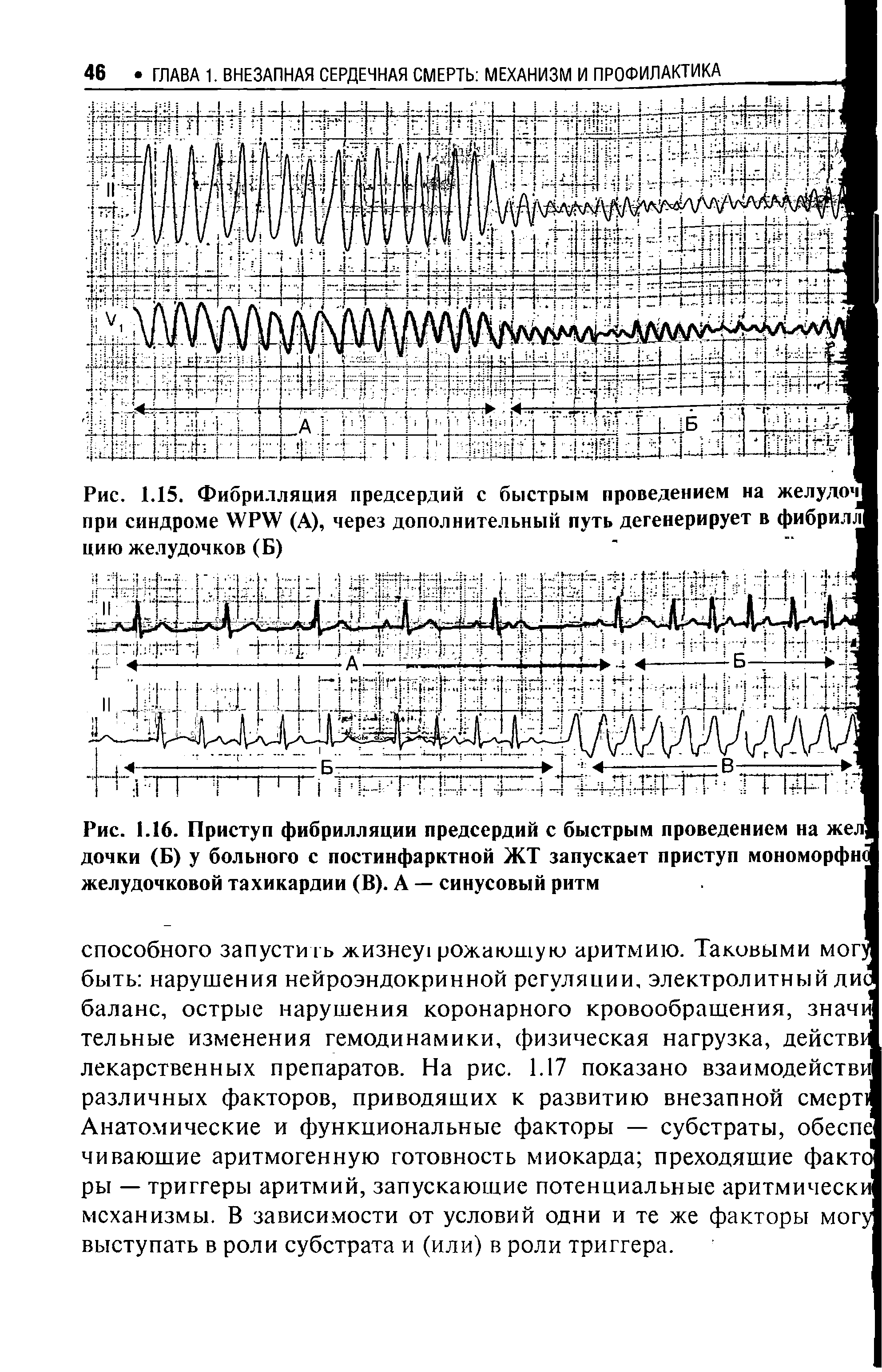 Рис. 1.15. Фибрилляция предсердий с быстрым проведением на желудоч при синдроме WPW (А), через дополнительный путь дегенерирует в фибрилл цию желудочков (Б)...