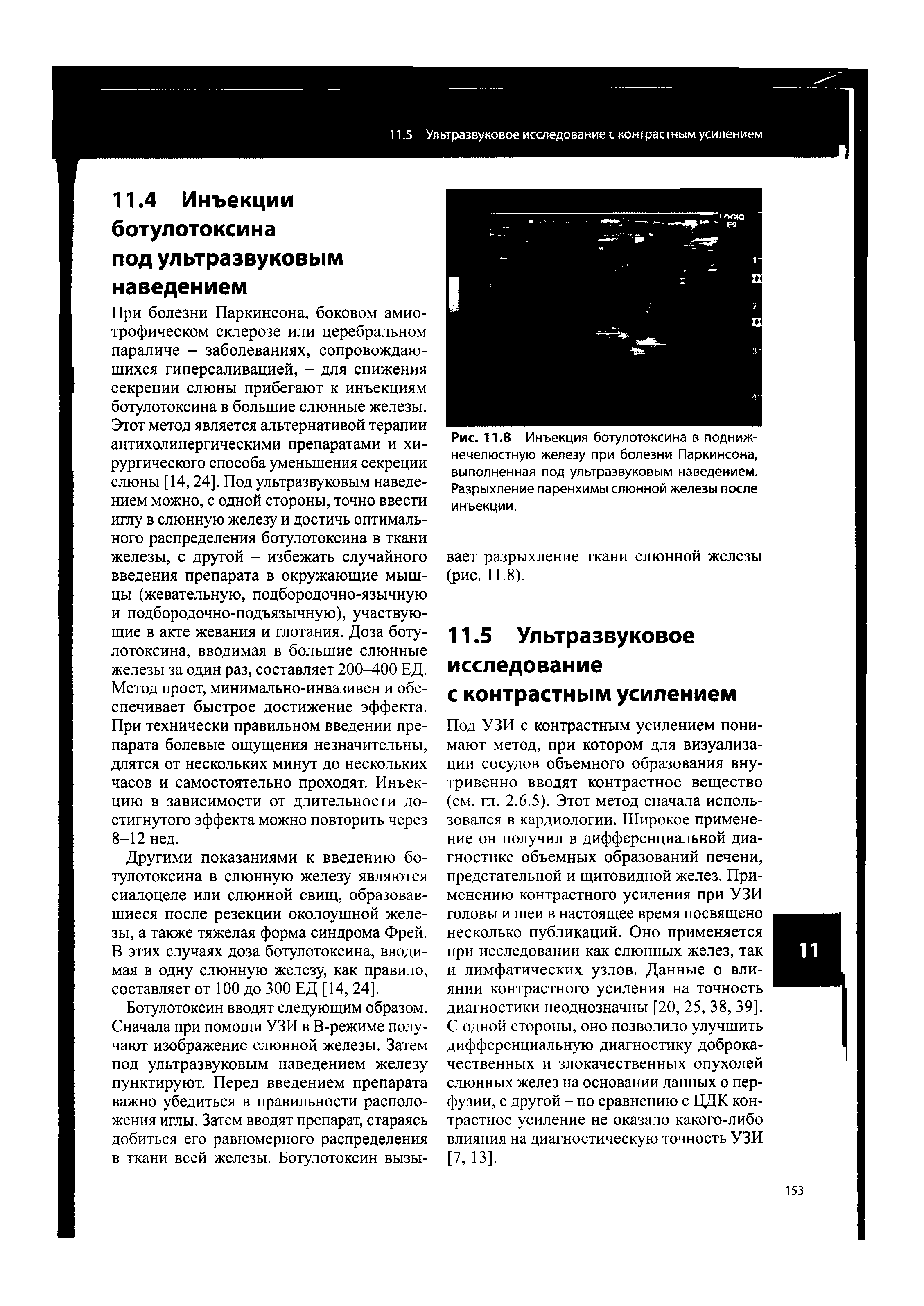 Рис. 11.8 Инъекция ботулотоксина в поднижнечелюстную железу при болезни Паркинсона, выполненная под ультразвуковым наведением. Разрыхление паренхимы слюнной железы после инъекции.