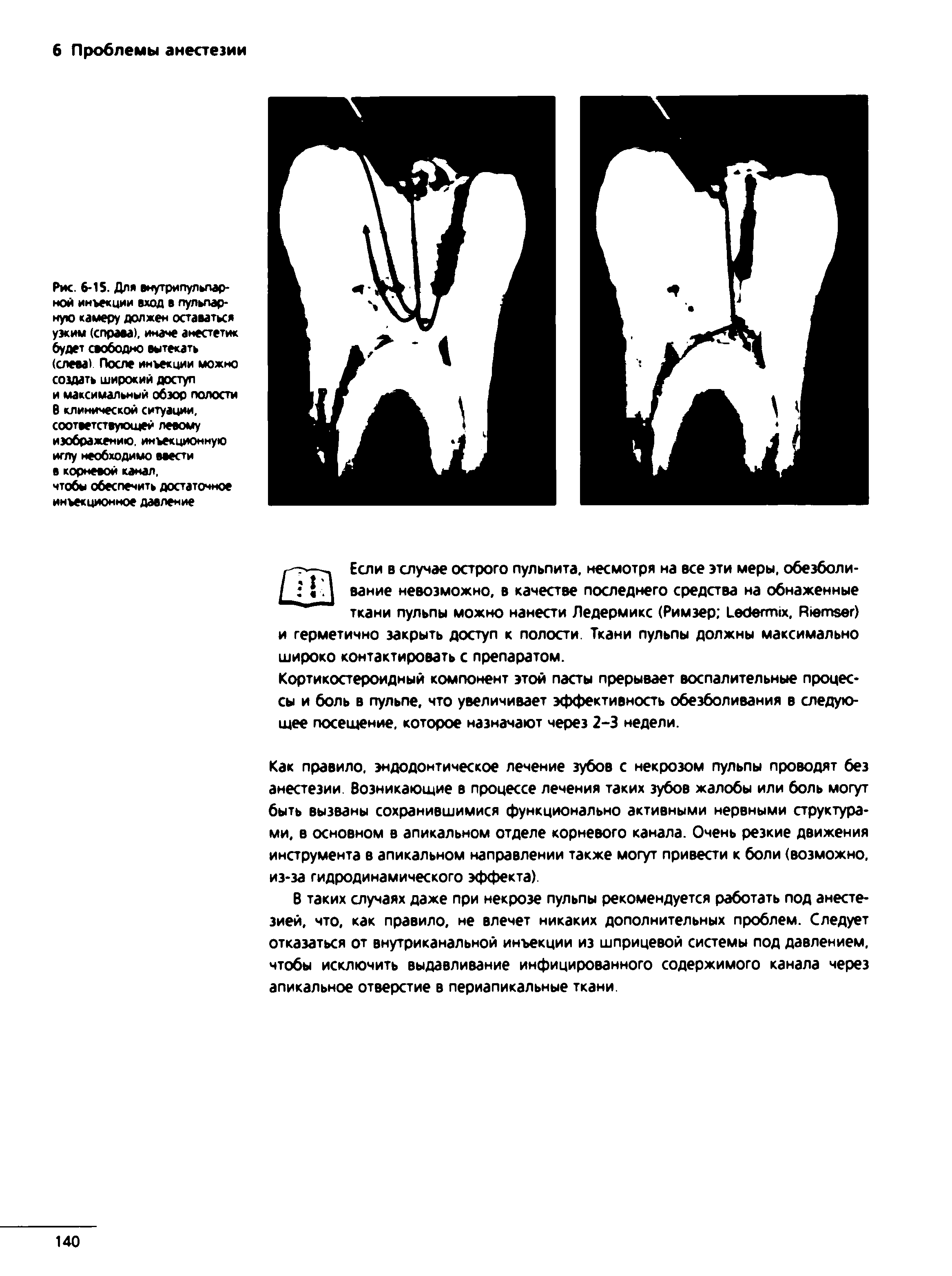 Рис. 6-15. Для виутрмпульпар-ной инъекции вход в пульпарную камеру должен оставаться узким (справа), иначе анестетик будет свободно вытекать (слева) После инъекции можно создать широкий доступ и максимальный обзор полости В клинической ситуации, соответствующей левому изображению инъекционную иглу необходимо ввести в корневой канал, чтобы обеспечить достаточное инъекционное давление...