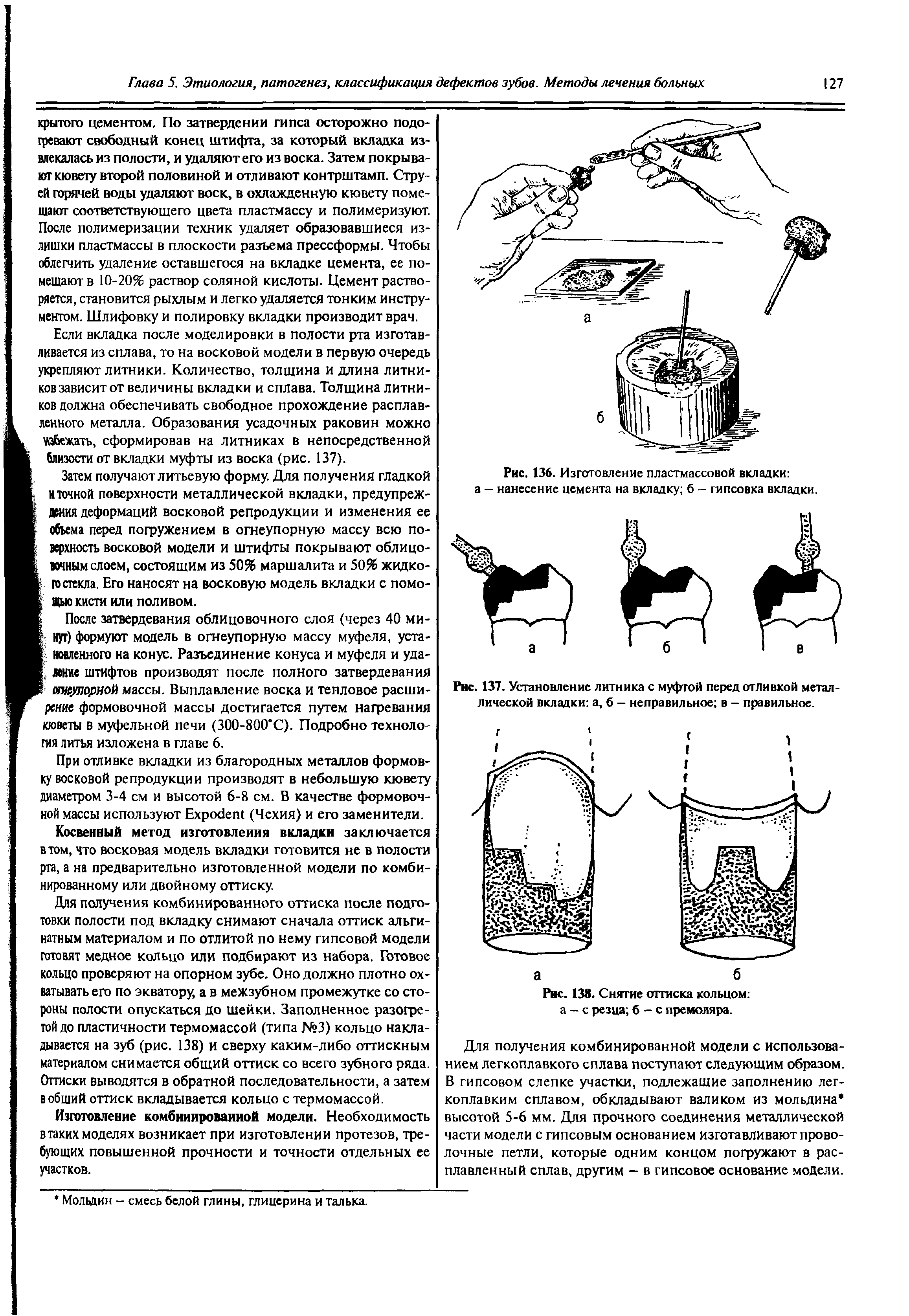 Рис. 136. Изготовление пластмассовой вкладки а - нанесение цемента на вкладку б - гипсовка вкладки.