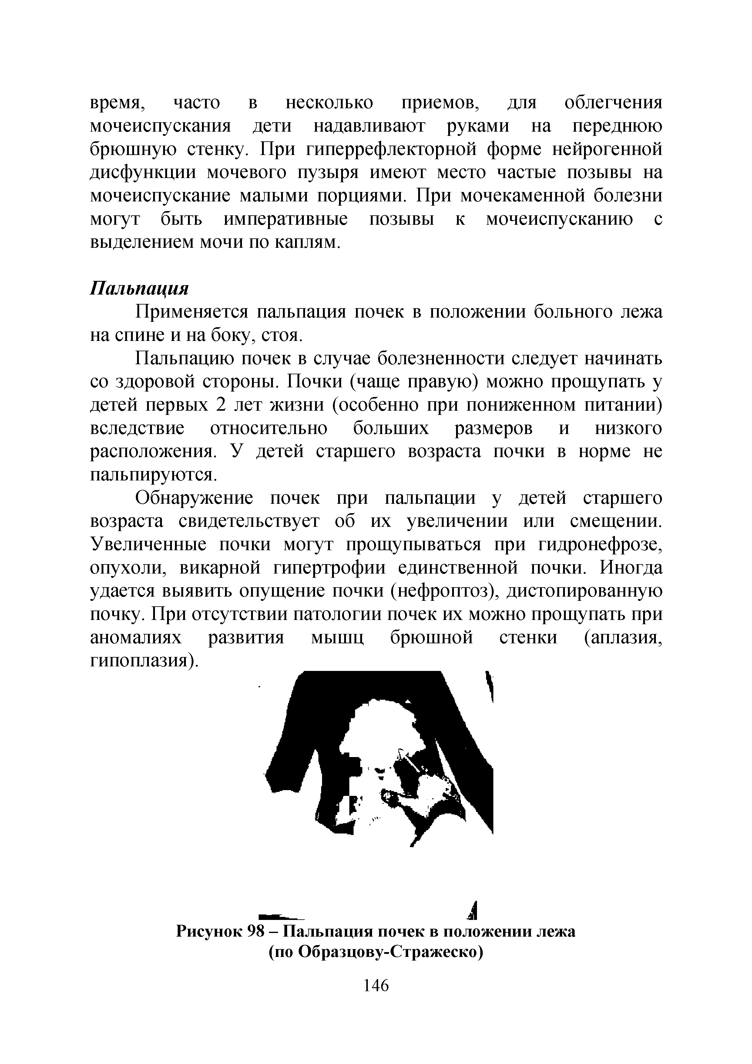 Рисунок 98 - Пальпация почек в положении лежа (по Образцову-Стражеско)...