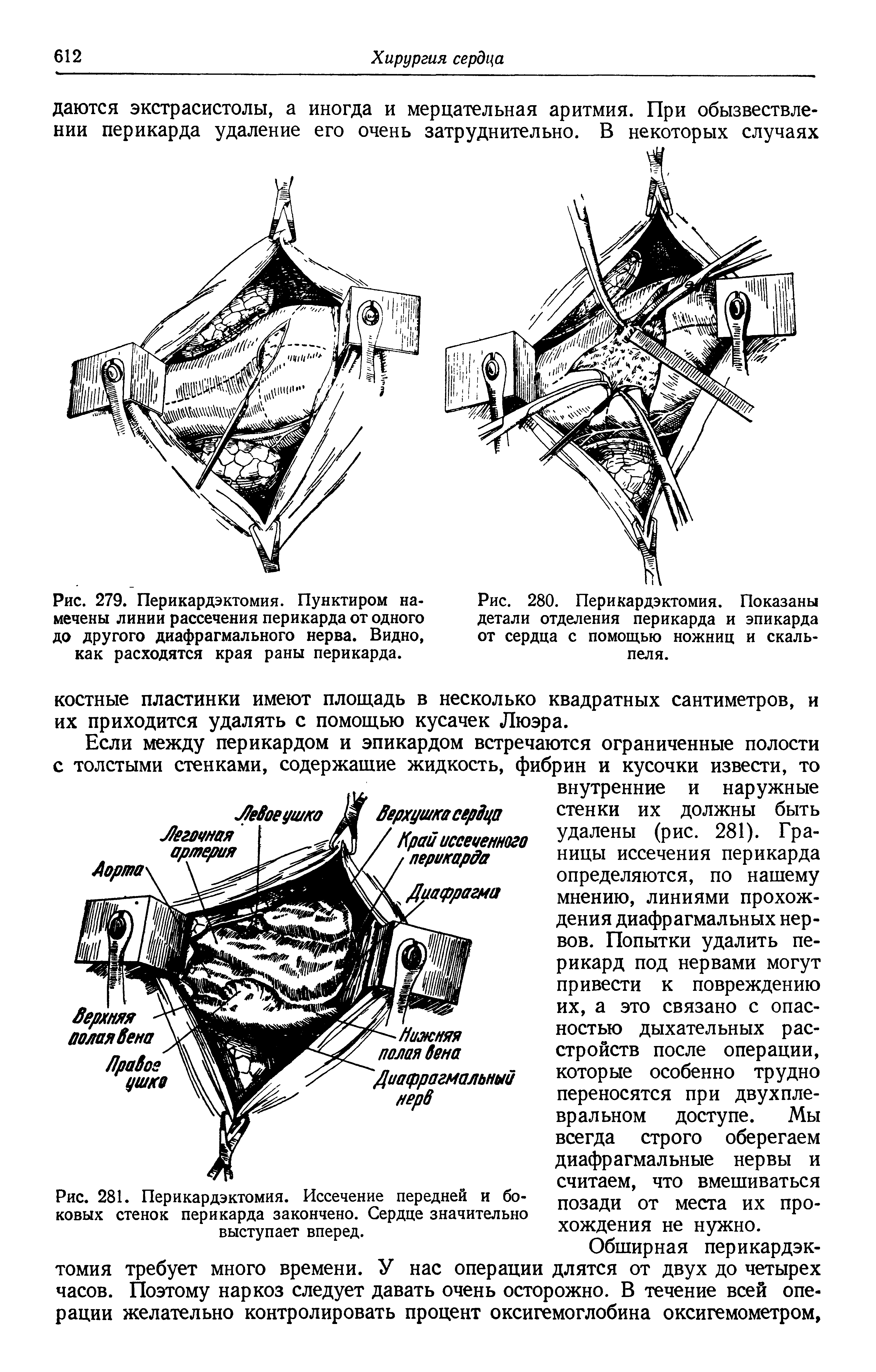 Рис. 281. Перикардэктомия. Иссечение передней и боковых стенок перикарда закончено. Сердце значительно выступает вперед.