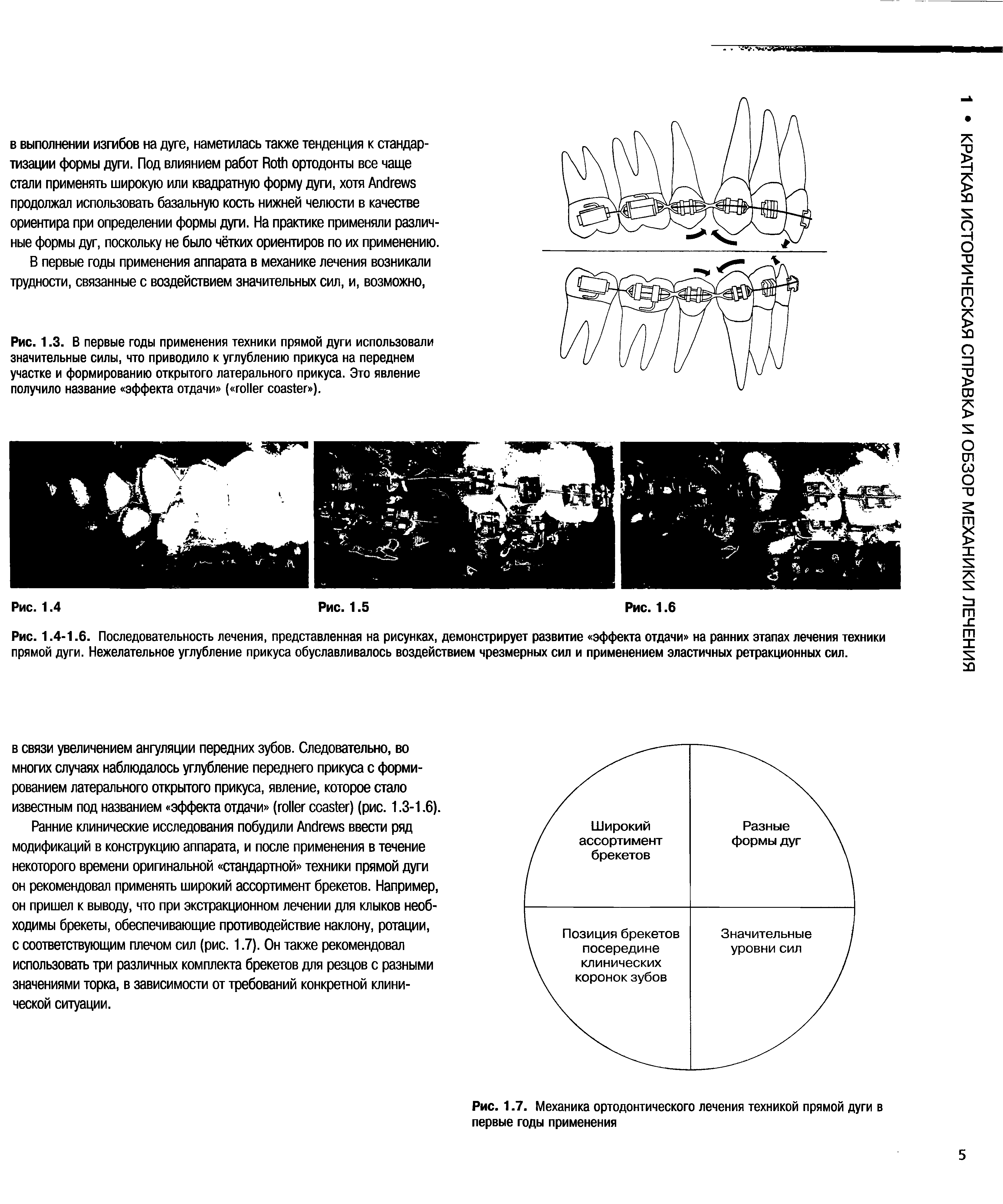 Рис. 1.4-1.6. Последовательность лечения, представленная на рисунках, демонстрирует развитие эффекта отдачи на ранних этапах лечения техники прямой дуги. Нежелательное углубление прикуса обуславливалось воздействием чрезмерных сил и применением эластичных ретракционных сил.