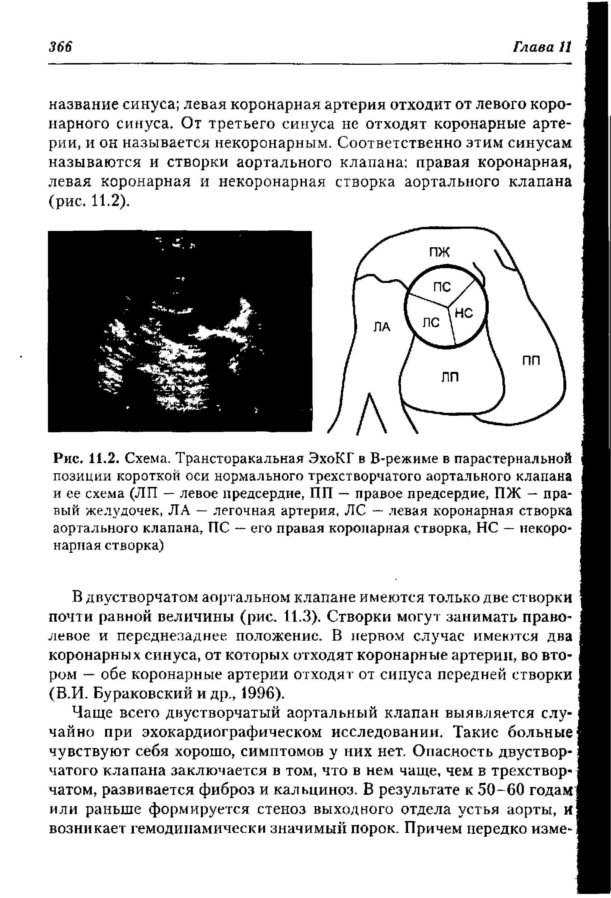 Рис. 11.2. Схема. Трансторакальная ЭхоКГ в В-режиме в парастернальной позиции короткой оси нормального трехстворчатого аортального клапана и ее схема (ЛП — левое предсердие, ПП — правое предсердие, ПЖ — правый желудочек, ЛА — легочная артерия, ЛС — левая коронарная створка аортального клапана, ПС — его правая коронарная створка, НС — некоро-нариая створка)...