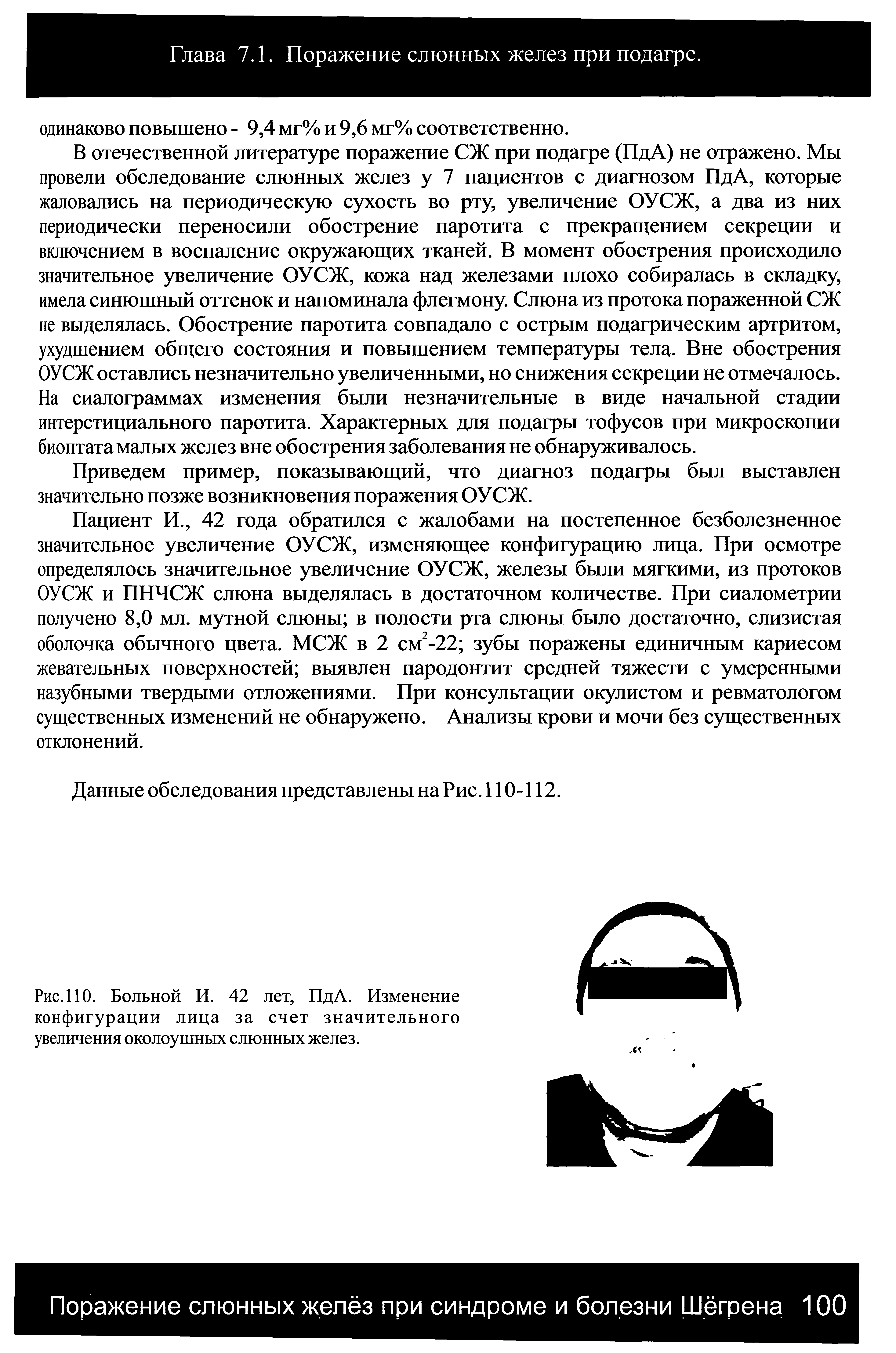 Рис.110. Больной И. 42 лет, ПдА. Изменение конфигурации лица за счет значительного увеличения околоушных слюнных желез.