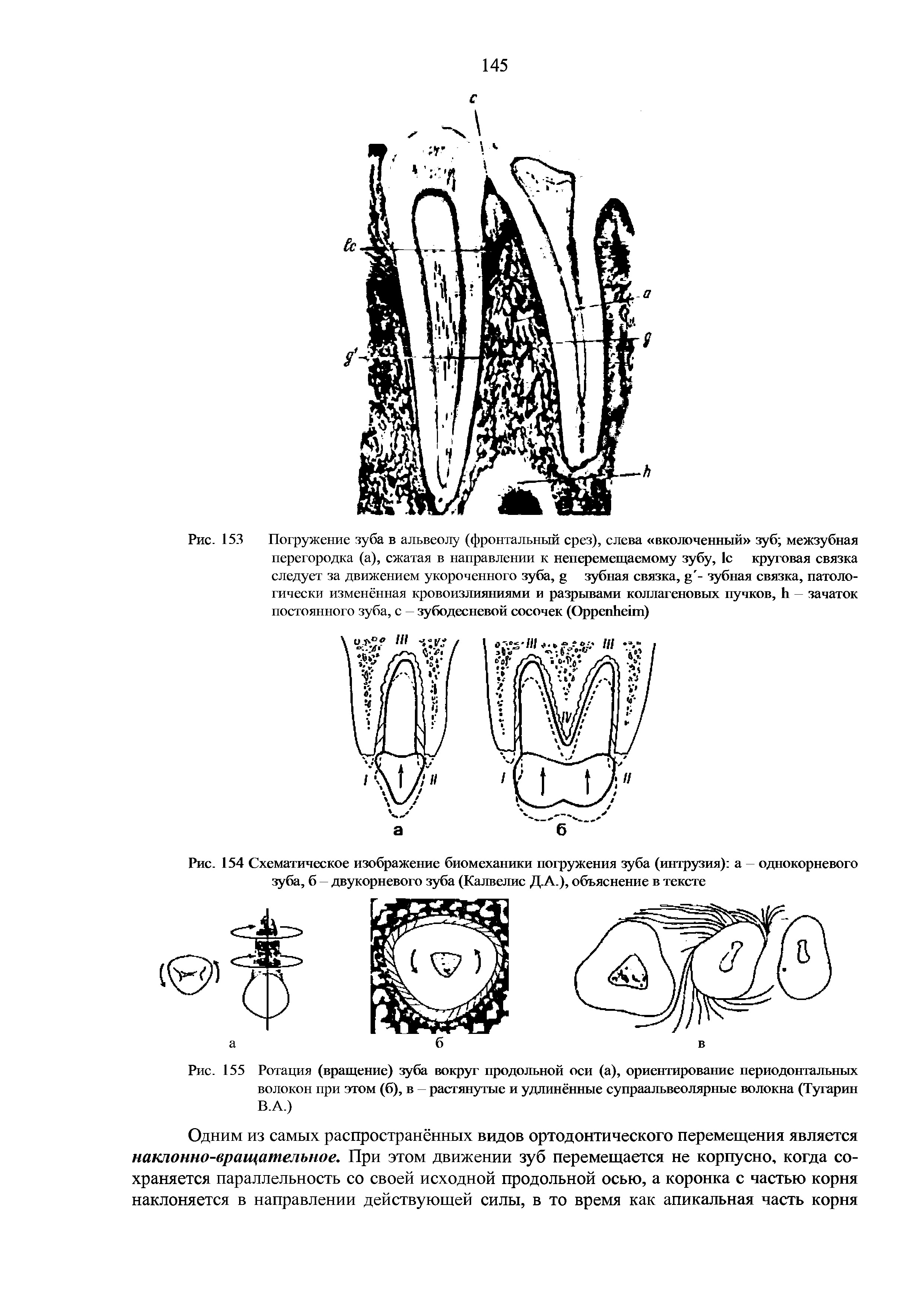 Рис. 153 Погружение зуба в альвеолу (фронтальный срез), слева вколоченный зуб межзубная перегородка (а), сжатая в направлении к неперемещаемому зубу, 1с круговая связка следует за движением укороченного зуба, зубная связка, - зубная связка, патологически изменённая кровоизлияниями и разрывами коллагеновых пучков, зачаток постоянного зуба, с зубодесневой сосочек (O )...