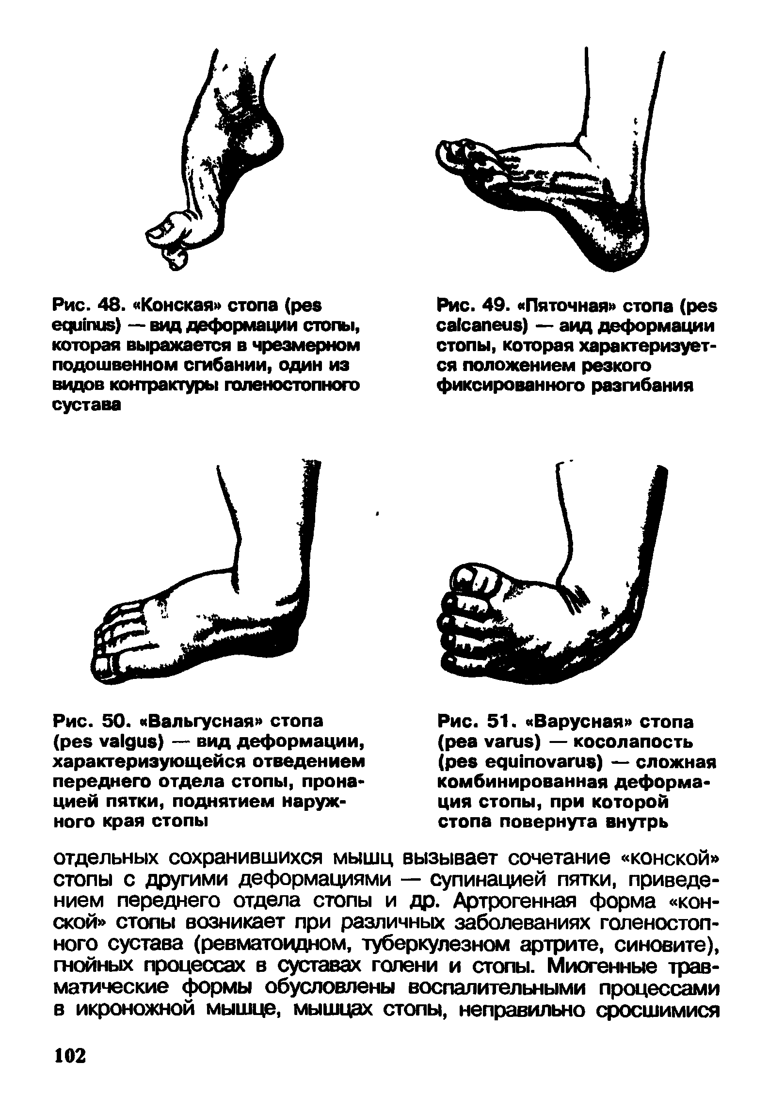 Рис. 50. Вальгусная стопа ( ) — вид деформации, характеризующейся отведением переднего отдела стопы, пронацией пятки, поднятием наружного края стопы...