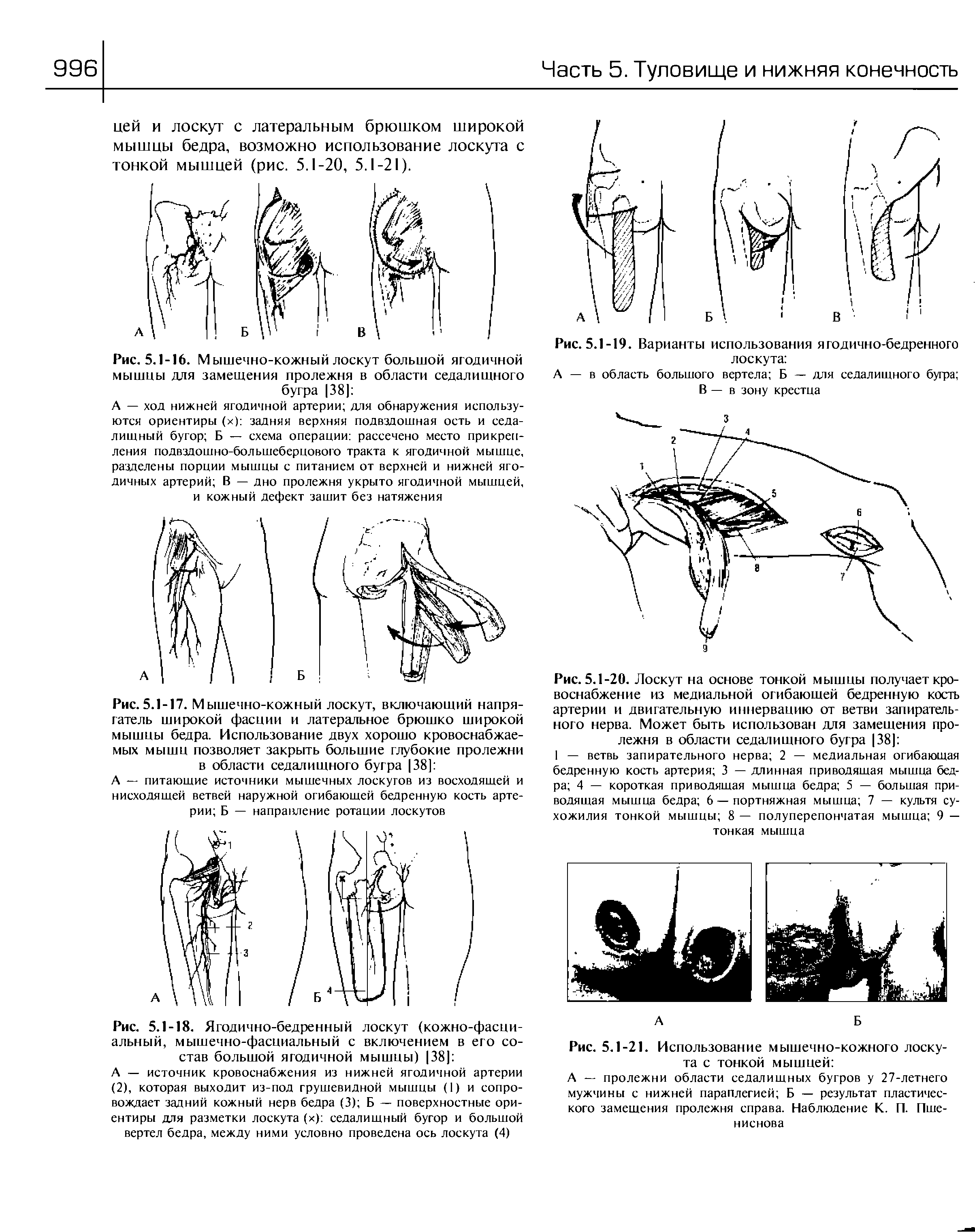 Рис. 5.1-17. Мышечно-кожный лоскут, включающий напрягатель широкой фасции и латеральное брюшко широкой мышцы бедра. Использование двух хорошо кровоснабжаемых мышц позволяет закрыть большие глубокие пролежни в области седалищного бугра 38] ...