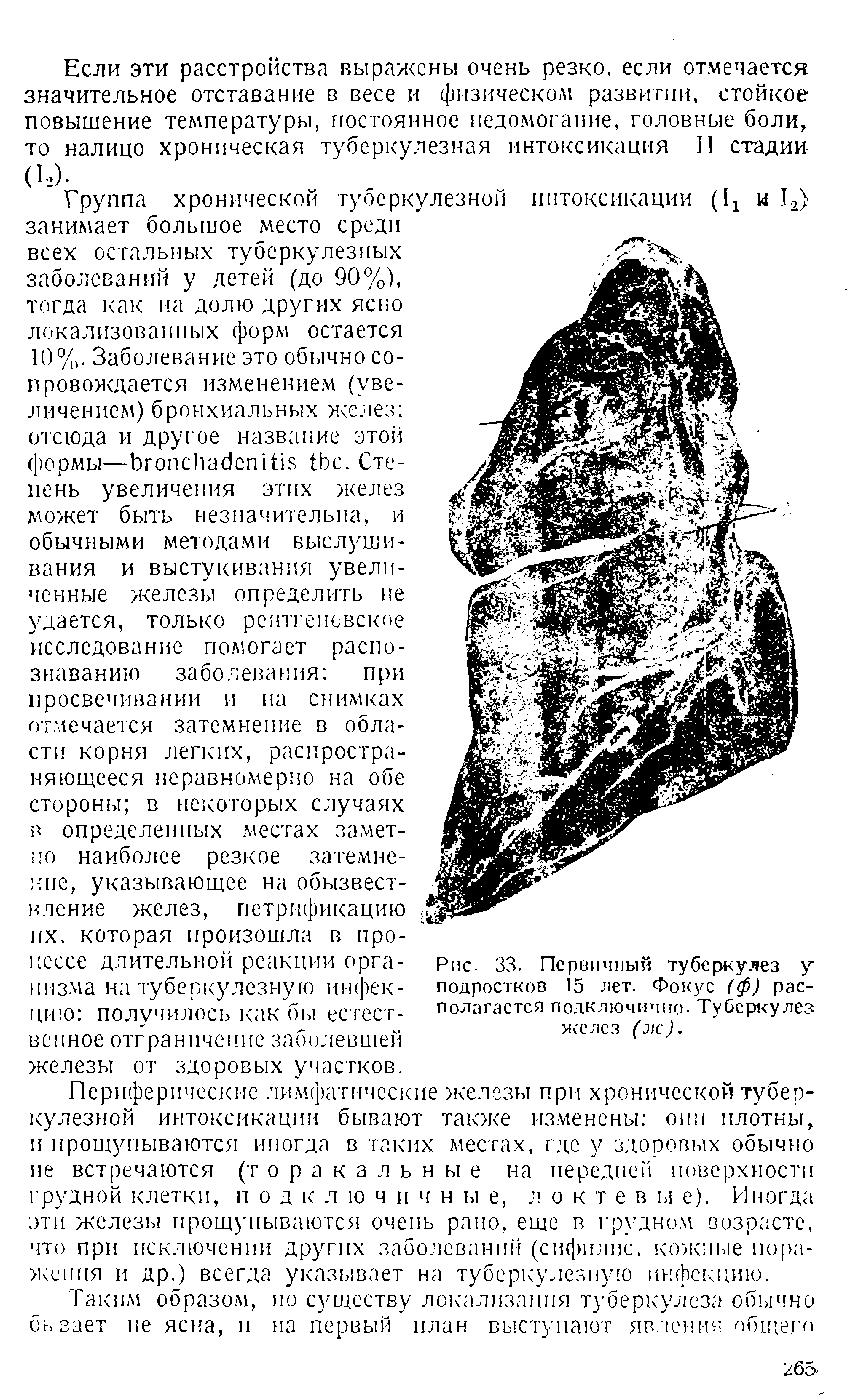 Рис. 33. Первичный туберкулез у подростков 15 лет. Фокус (ф) располагается подключим но - Туберкулез желез (ж).