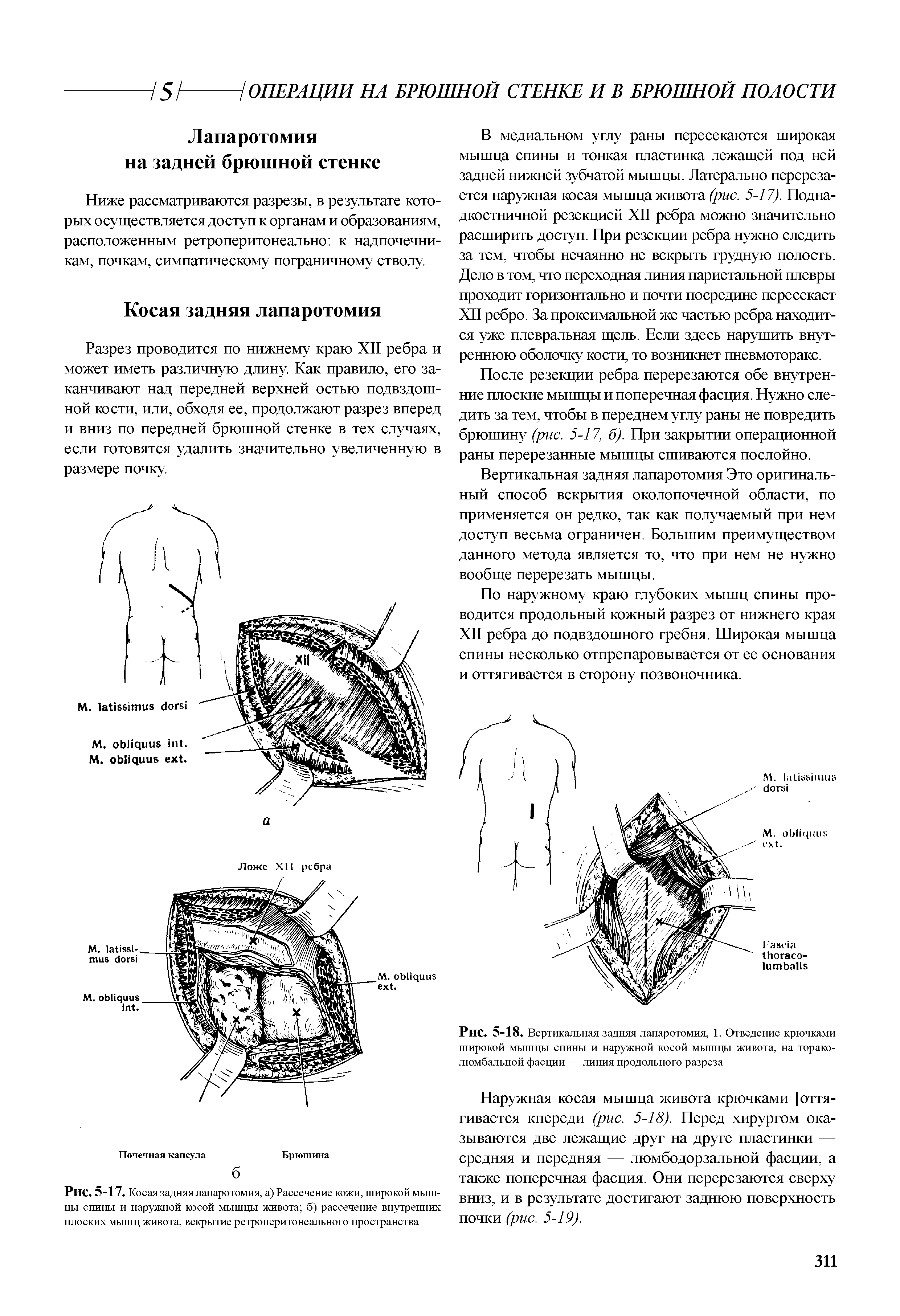 Рис. 5-18. Вертикальная задняя лапаротомия, 1. Отведение крючками широкой мышцы спины и наружной косой мышцы живота, на тораколюмбальной фасции — линия продольного разреза...