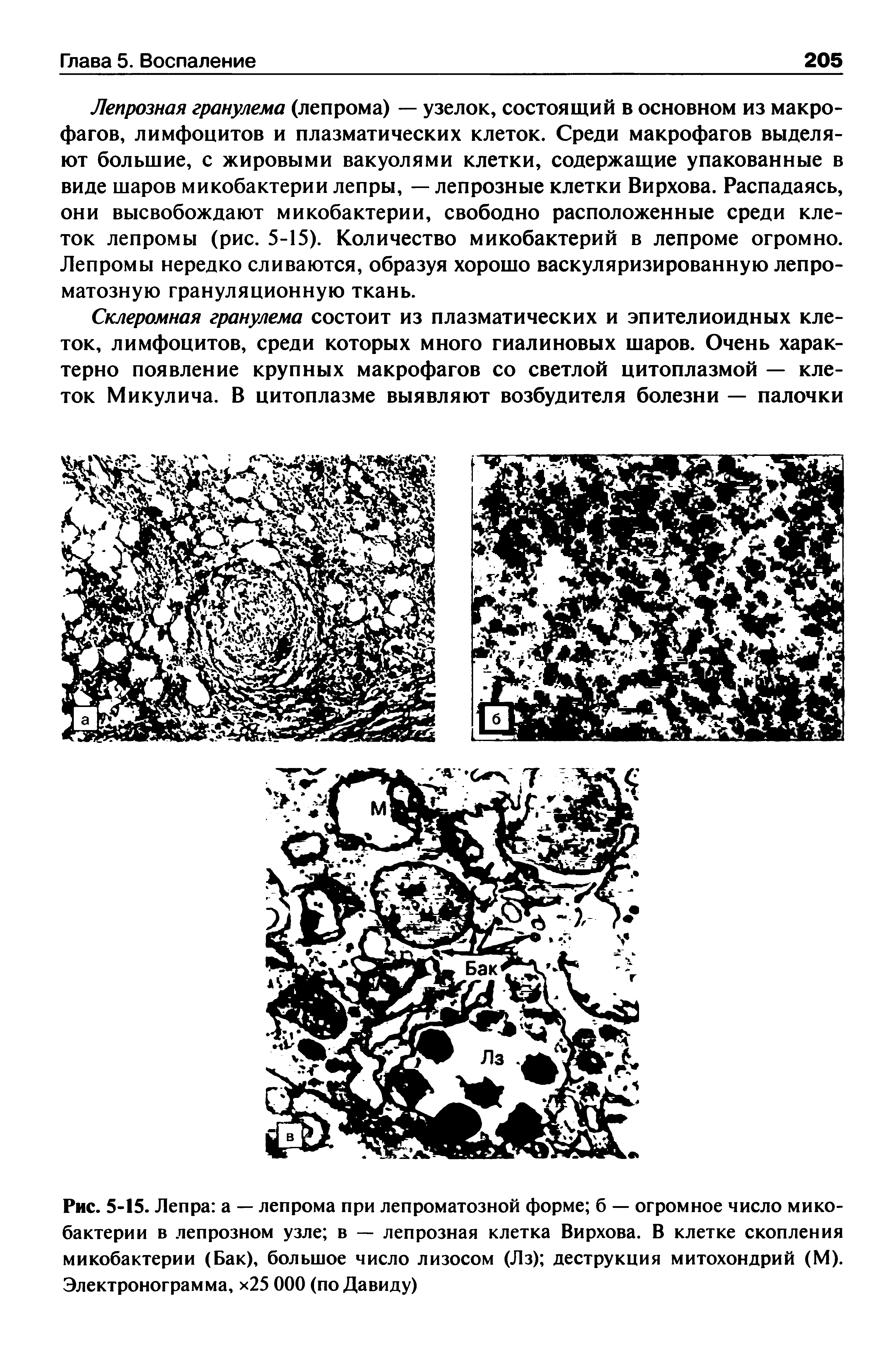 Рис. 5-15. Лепра а — лепрома при лепроматозной форме б — огромное число микобактерии в лепрозном узле в — лепрозная клетка Вирхова. В клетке скопления микобактерии (Бак), большое число лизосом (Лз) деструкция митохондрий (М). Электронограмма, х25 ООО (по Давиду)...