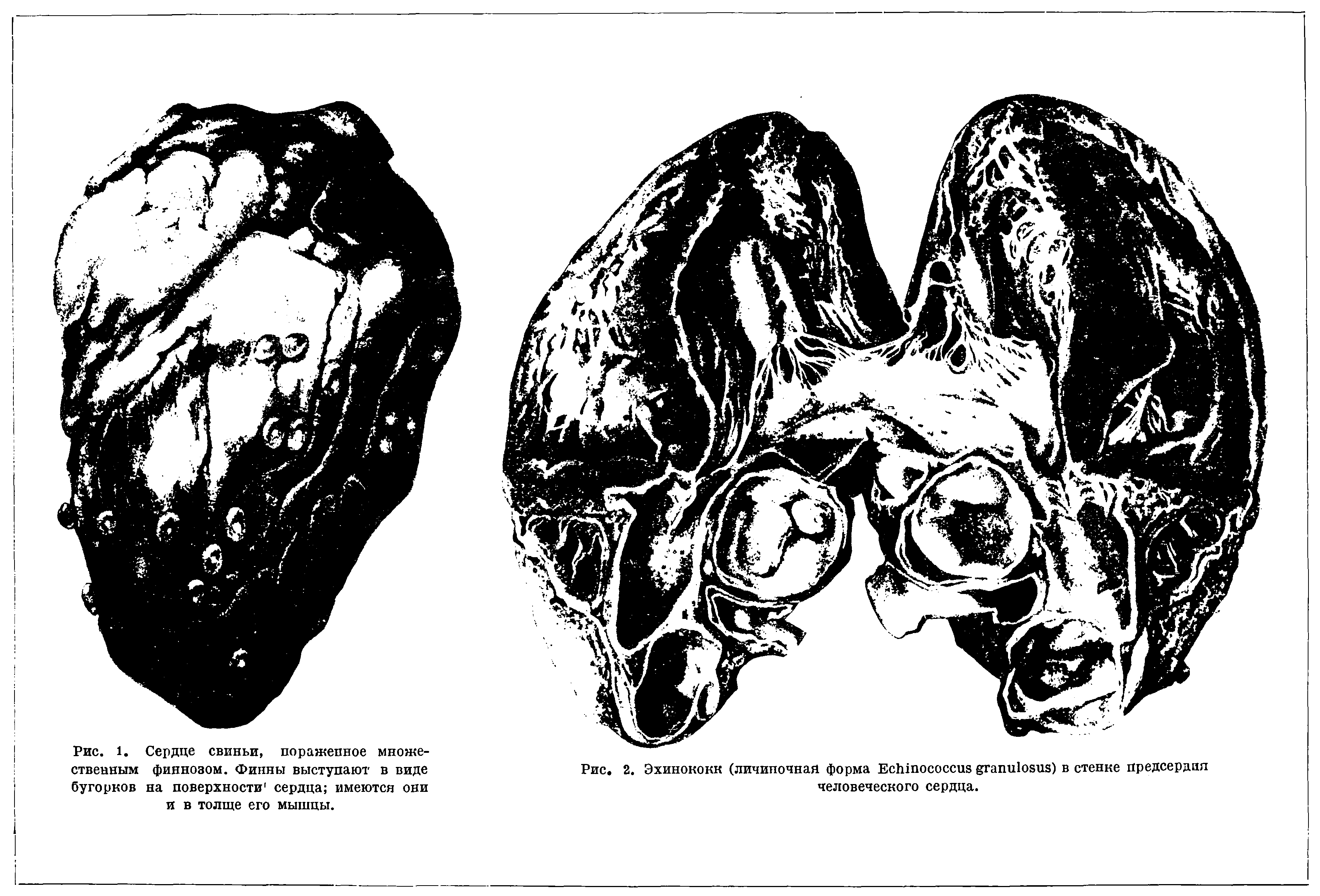 Рис. 2. Эхинококк (личипочная форма E ) в стенке предсердия человеческого сердца.