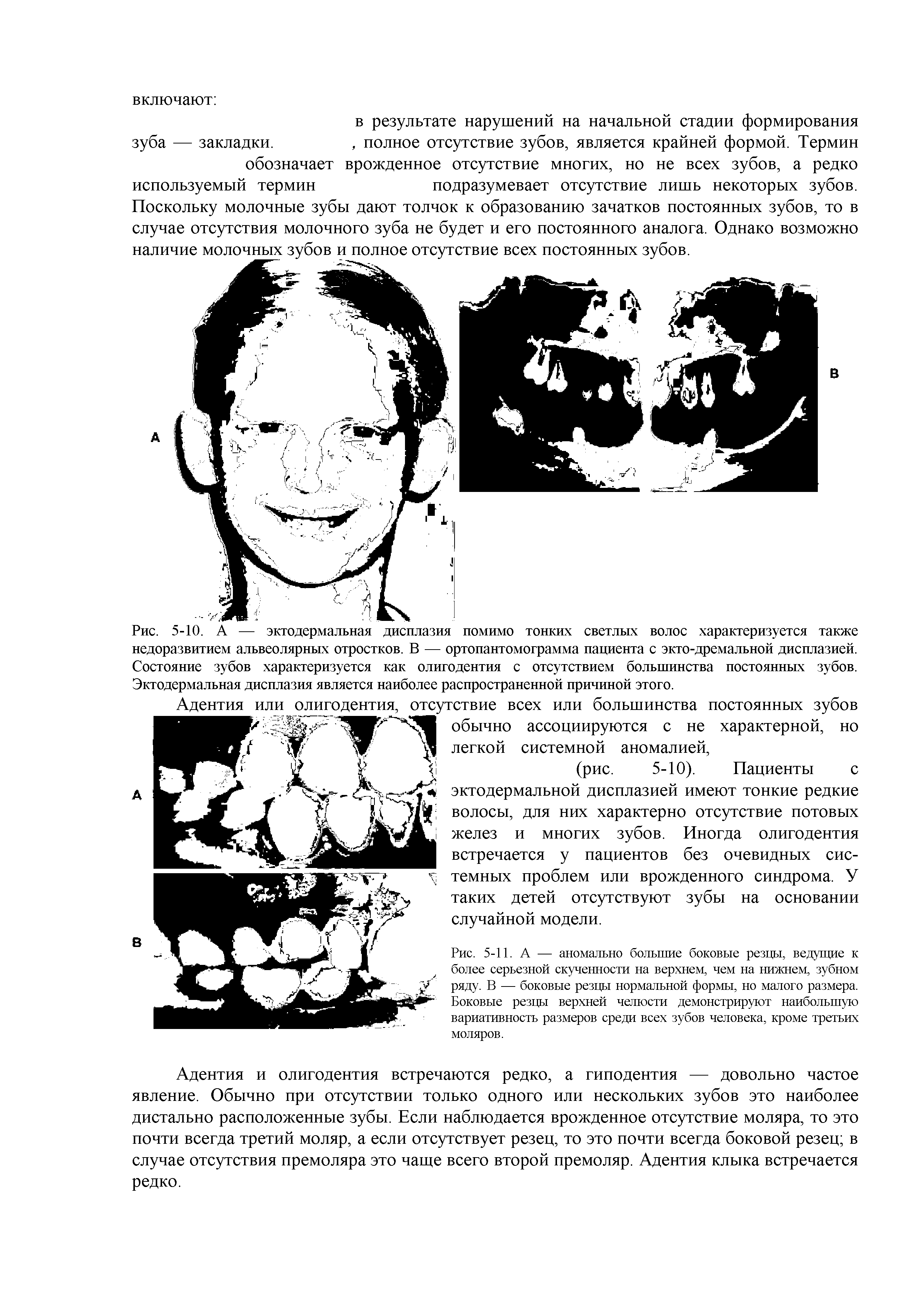 Рис. 5-10. А — эктодермальная дисплазия помимо тонких светлых волос характеризуется также недоразвитием альвеолярных отростков. В — ортопантомограмма пациента с экто-дремальной дисплазией. Состояние зубов характеризуется как олигодентия с отсутствием большинства постоянных зубов. Эктодермальная дисплазия является наиболее распространенной причиной этого.
