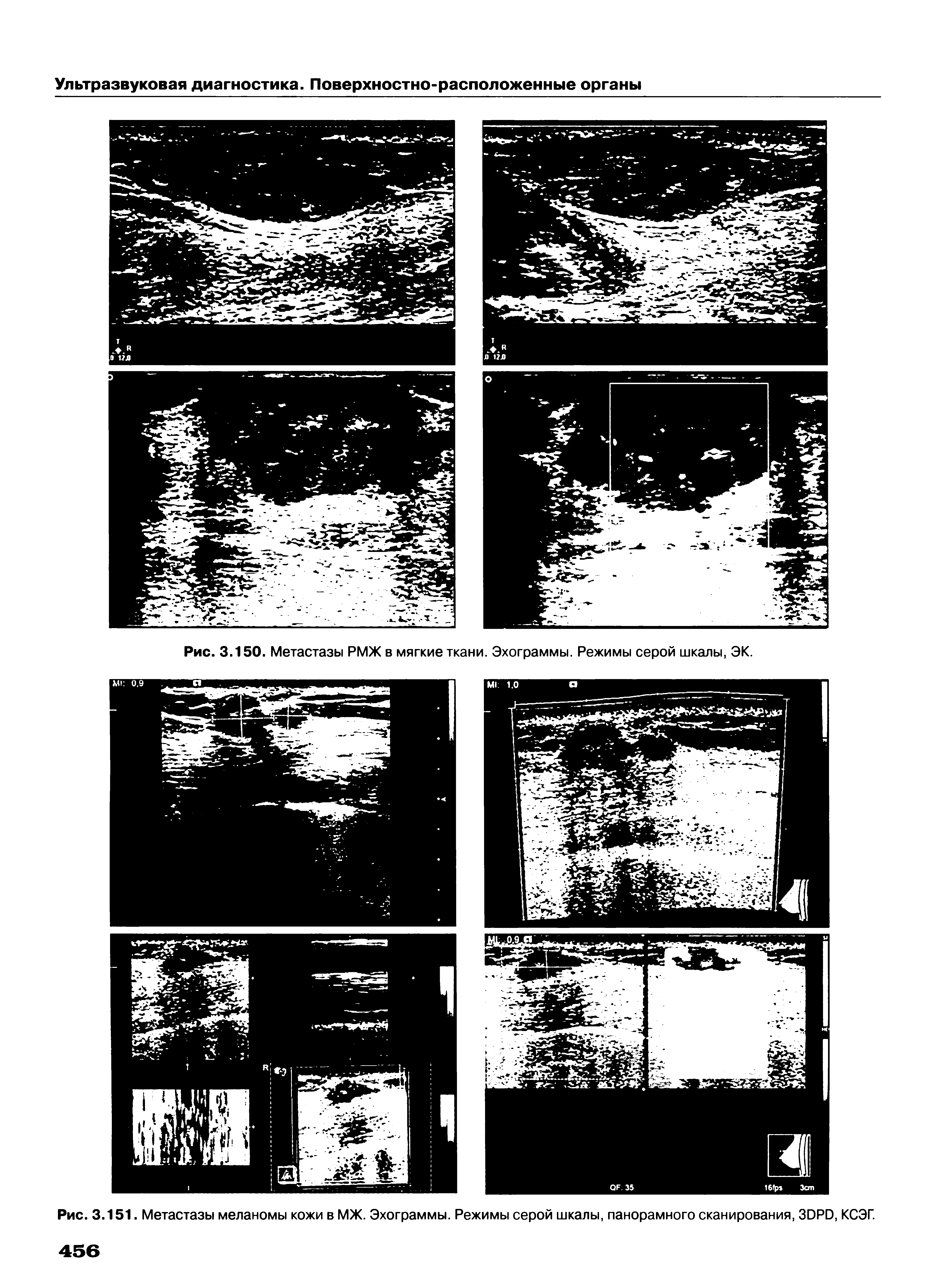 Рис. 3.151. Метастазы меланомы кожи в МЖ. Эхограммы. Режимы серой шкалы, панорамного сканирования, ЗЭРЭ, КСЭГ.