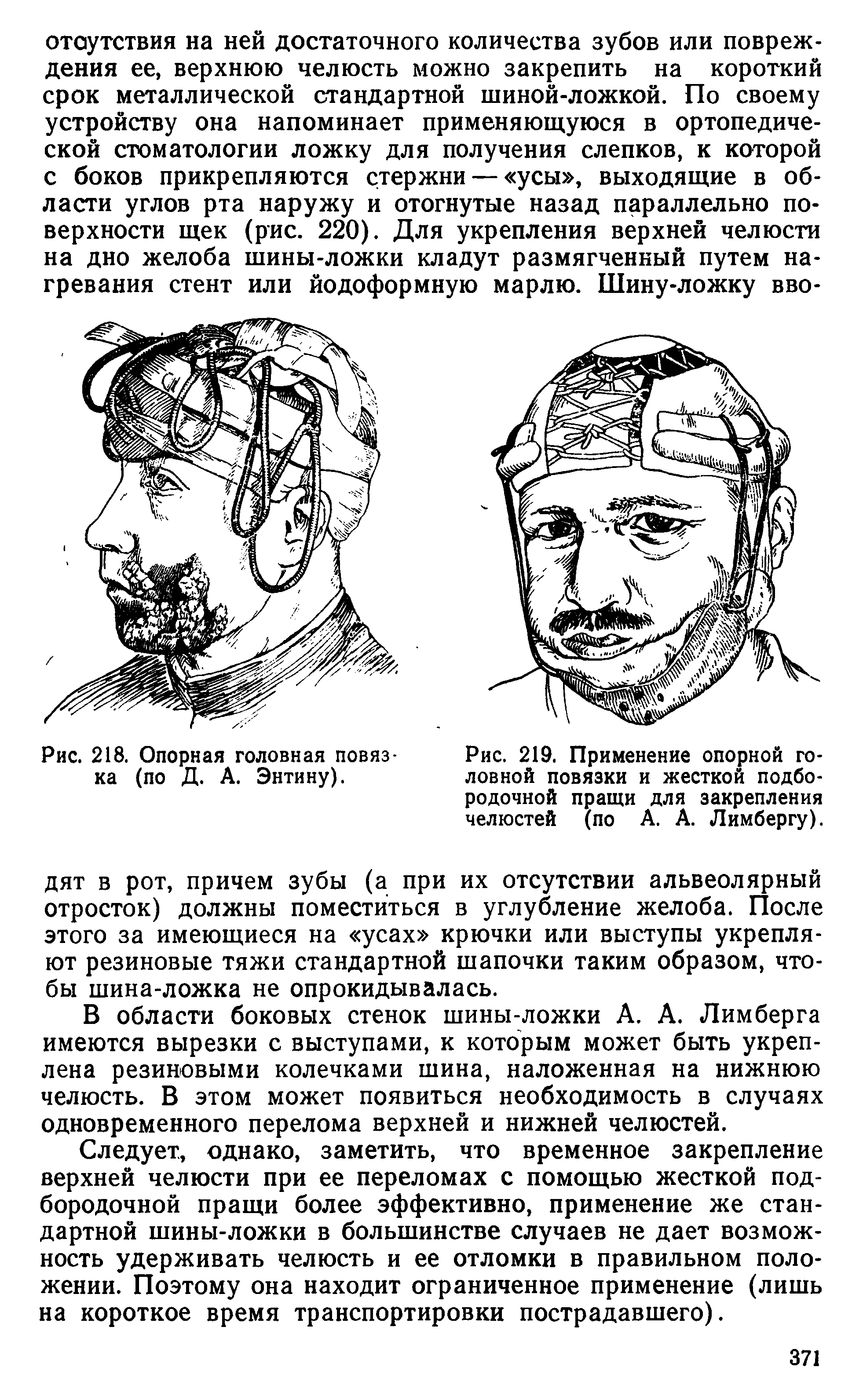 Рис. 219. Применение опорной головной повязки и жесткой подбородочной пращи для закрепления челюстей (по А. А. Лимбергу).