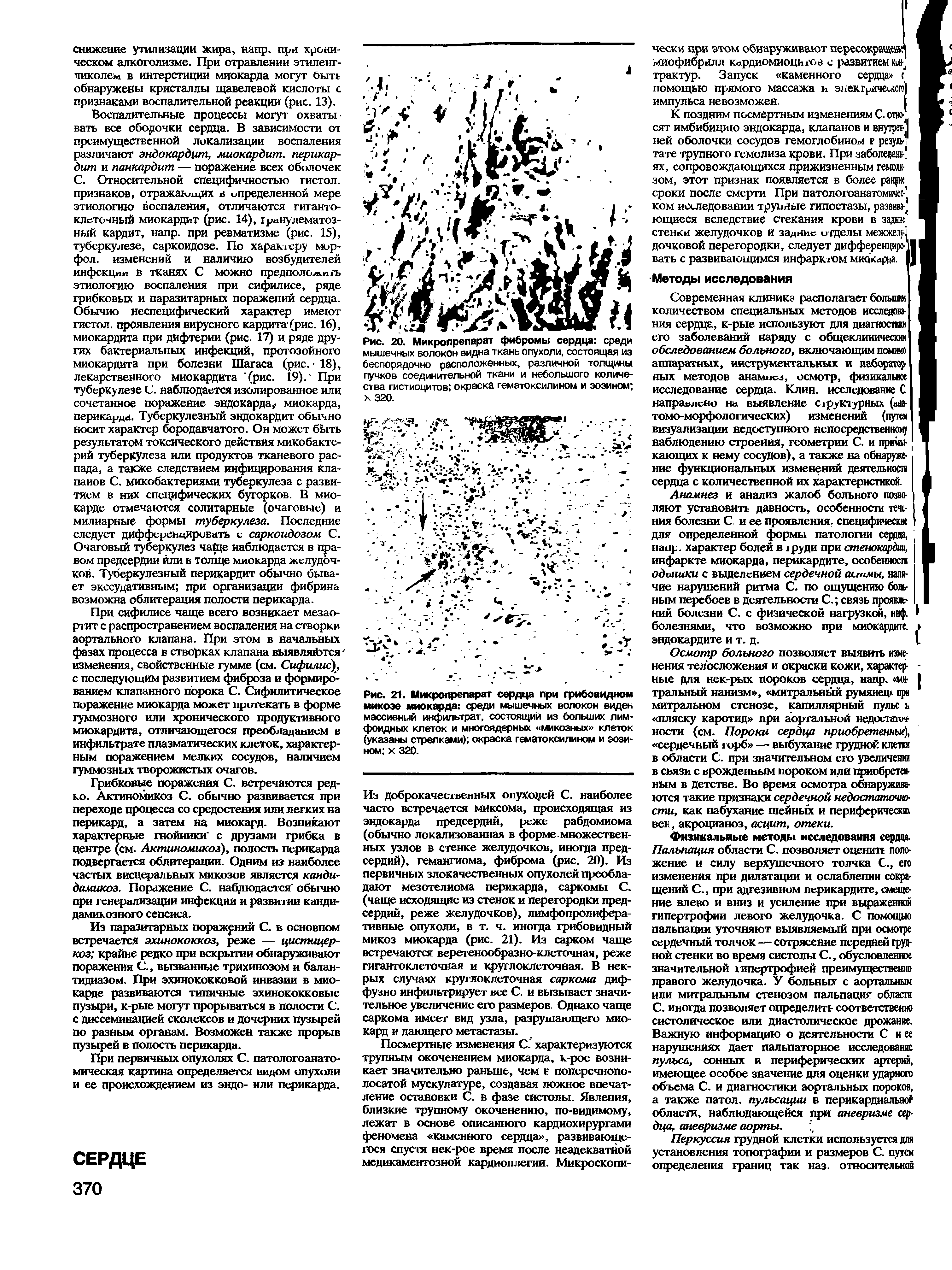 Рис. 21. Микропрепарат сердца при грибовидном микозе миокарда среди мышечных волокон виден массивный инфильтрат, состоящий из больших лимфоидных клеток и многоядерных микозных клеток (указаны стрелками) окраска гематоксилином и эозином х 320.