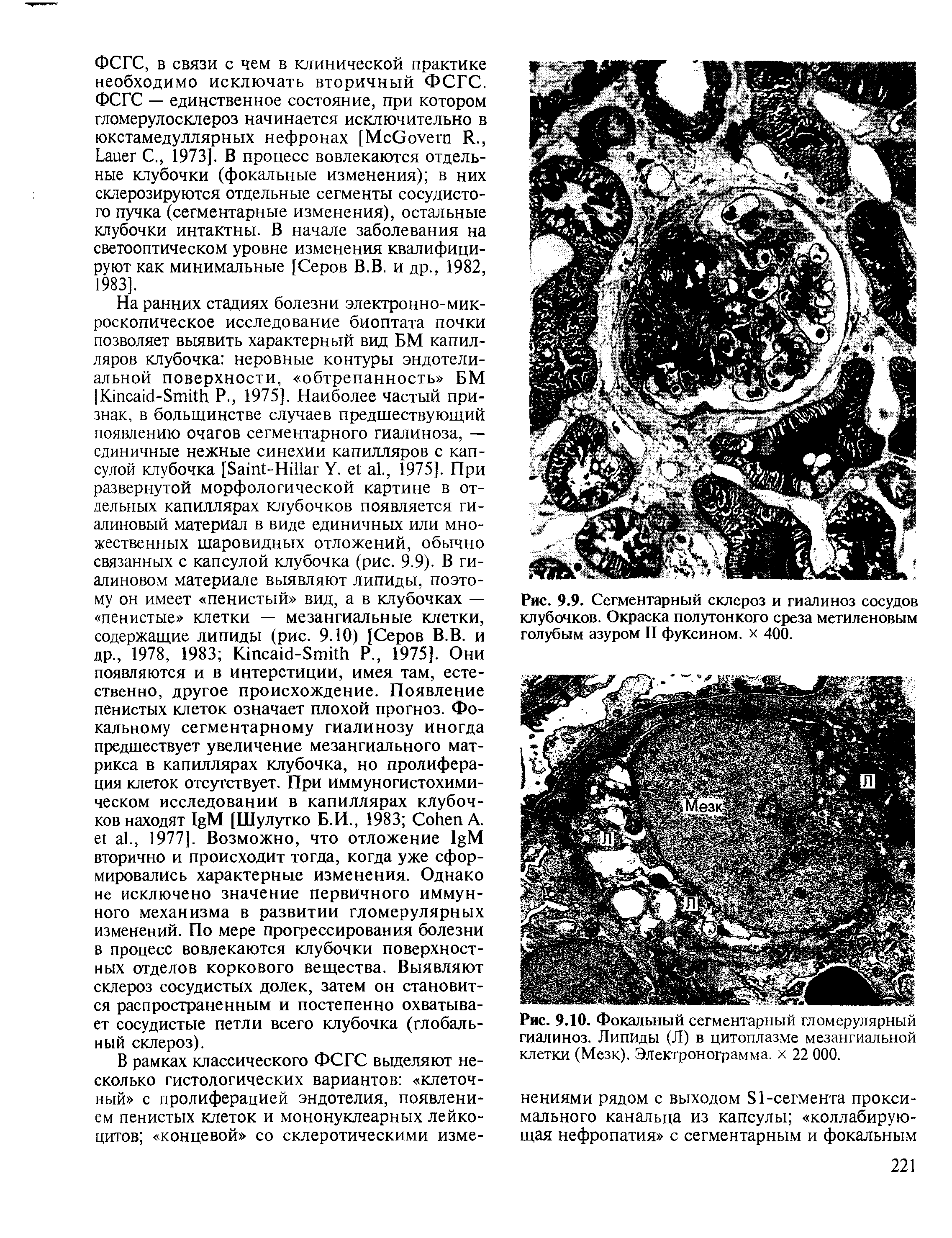 Рис. 9.10. Фокальный сегментарный гломерулярный гиалиноз. Липиды (Л) в цитоплазме мезангиальной клетки (Мезк). Электронограмма. х 22 000.