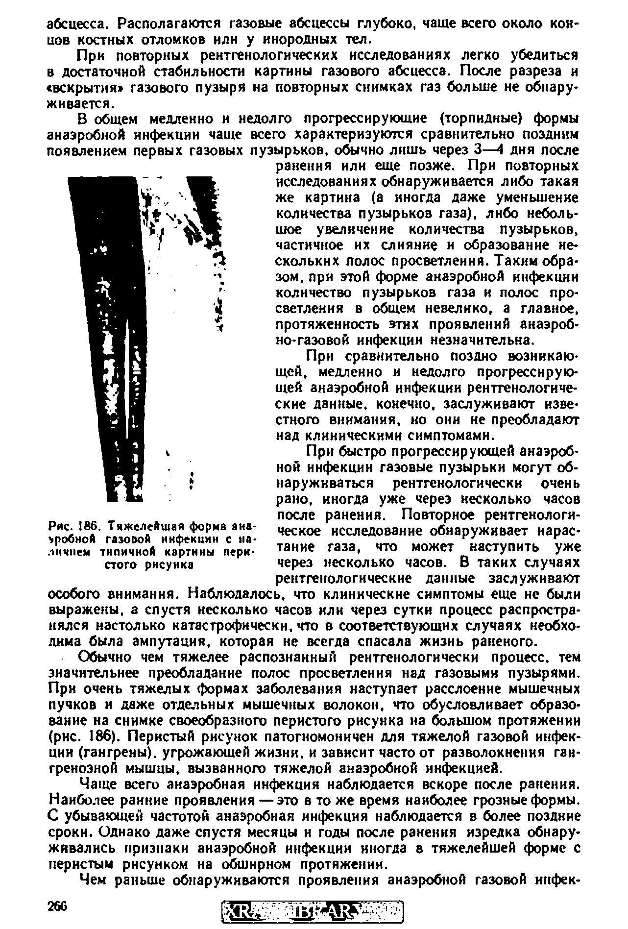 Рис. 186. Тяжелейшая форма анаэробной газовой инфекции с наличием типичной картины перистого рисунка...