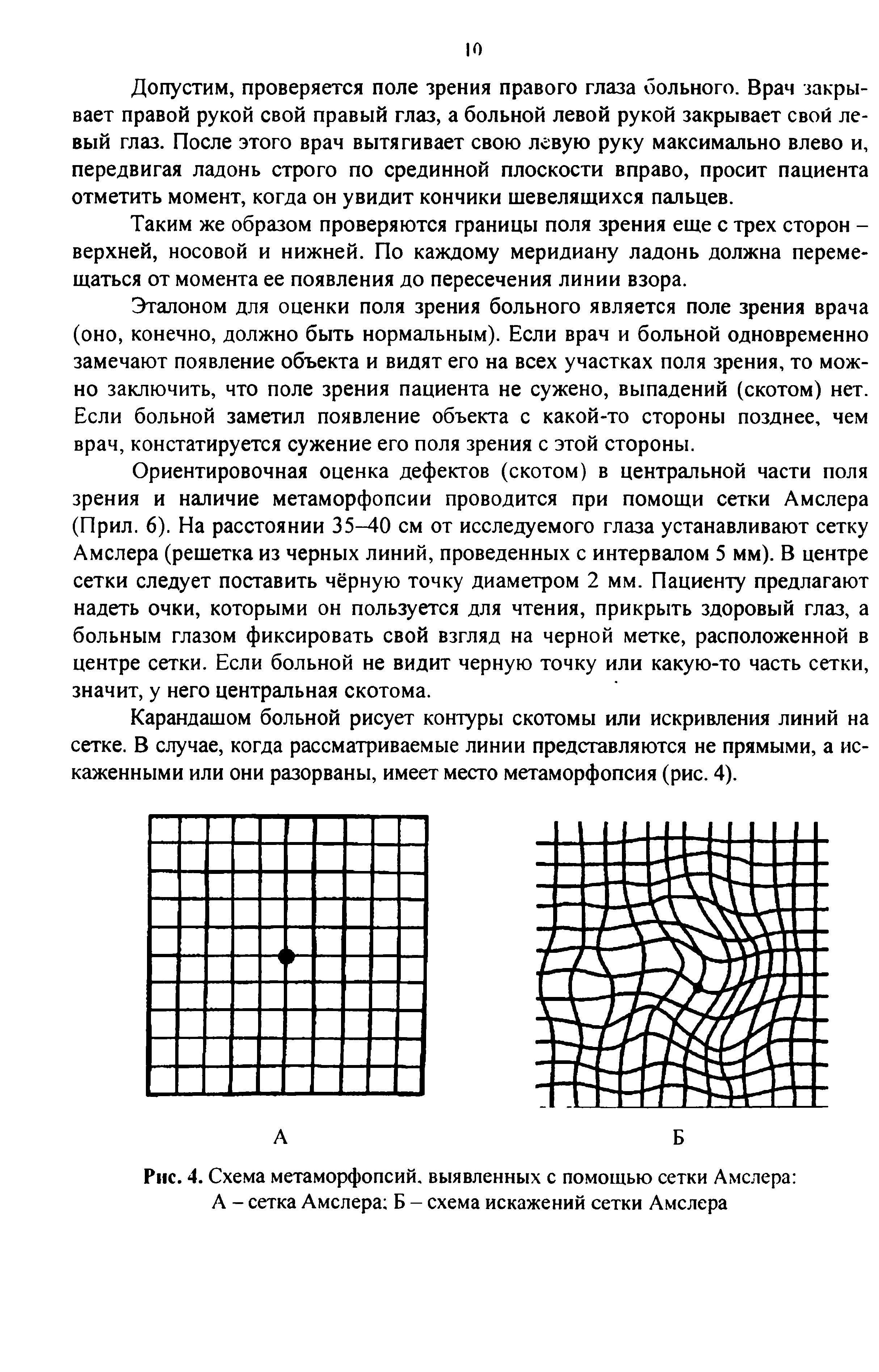 Рис. 4. Схема метаморфопсий. выявленных с помощью сетки Амслера А - сетка Амслера Б - схема искажений сетки Амслера...