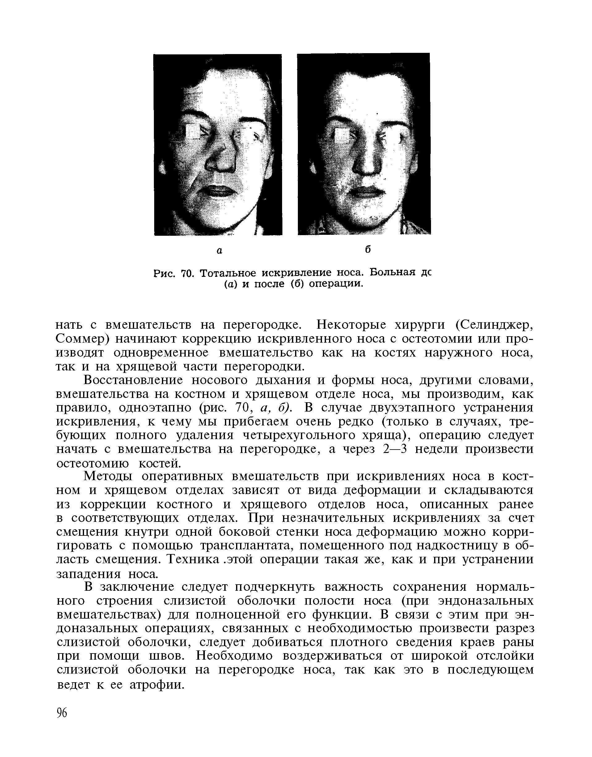 Рис. 70. Тотальное искривление носа. Больная дс (а) и после (б) операции.