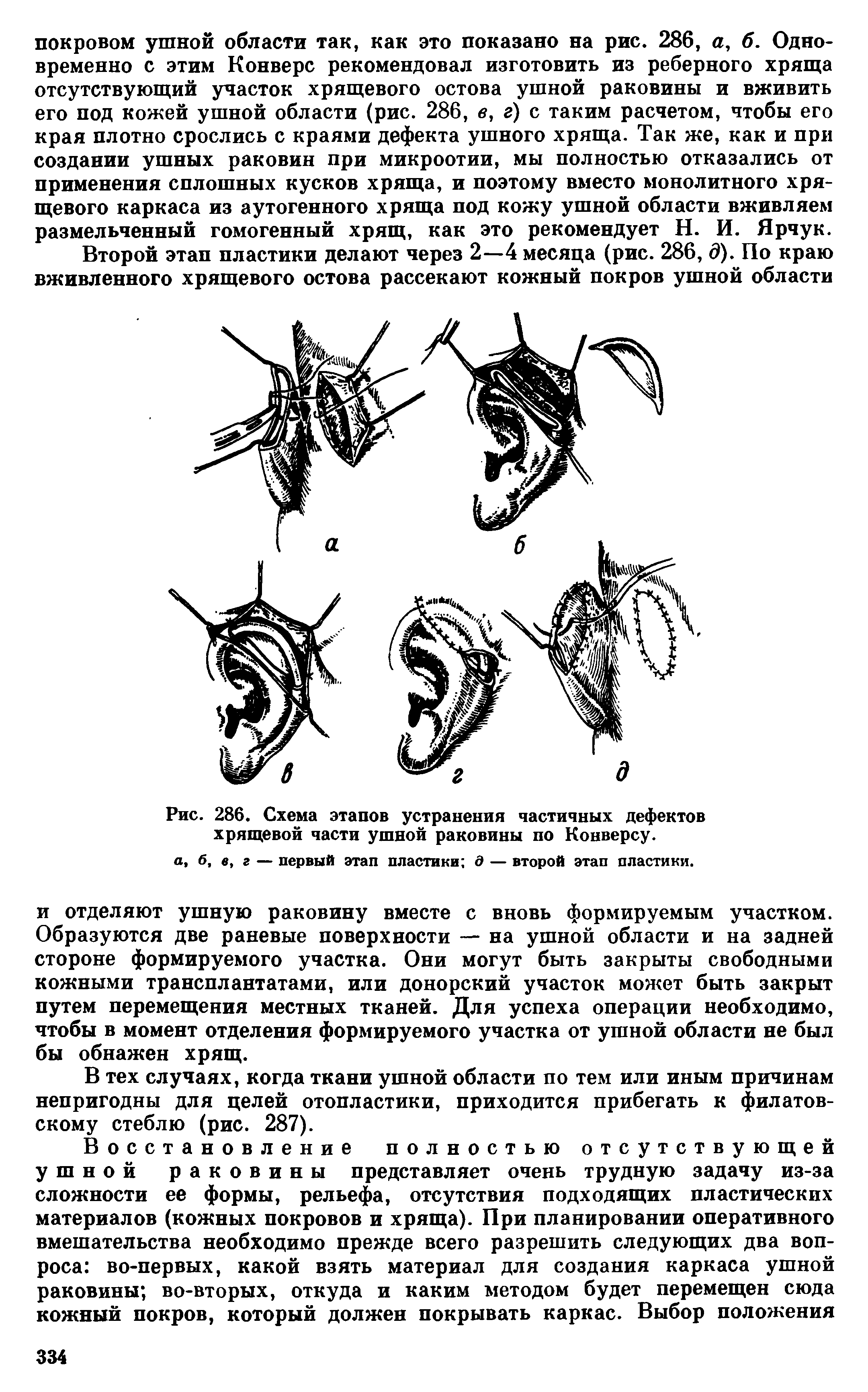 Рис. 286. Схема этапов устранения частичных дефектов хрящевой части ушной раковины по Конверсу.