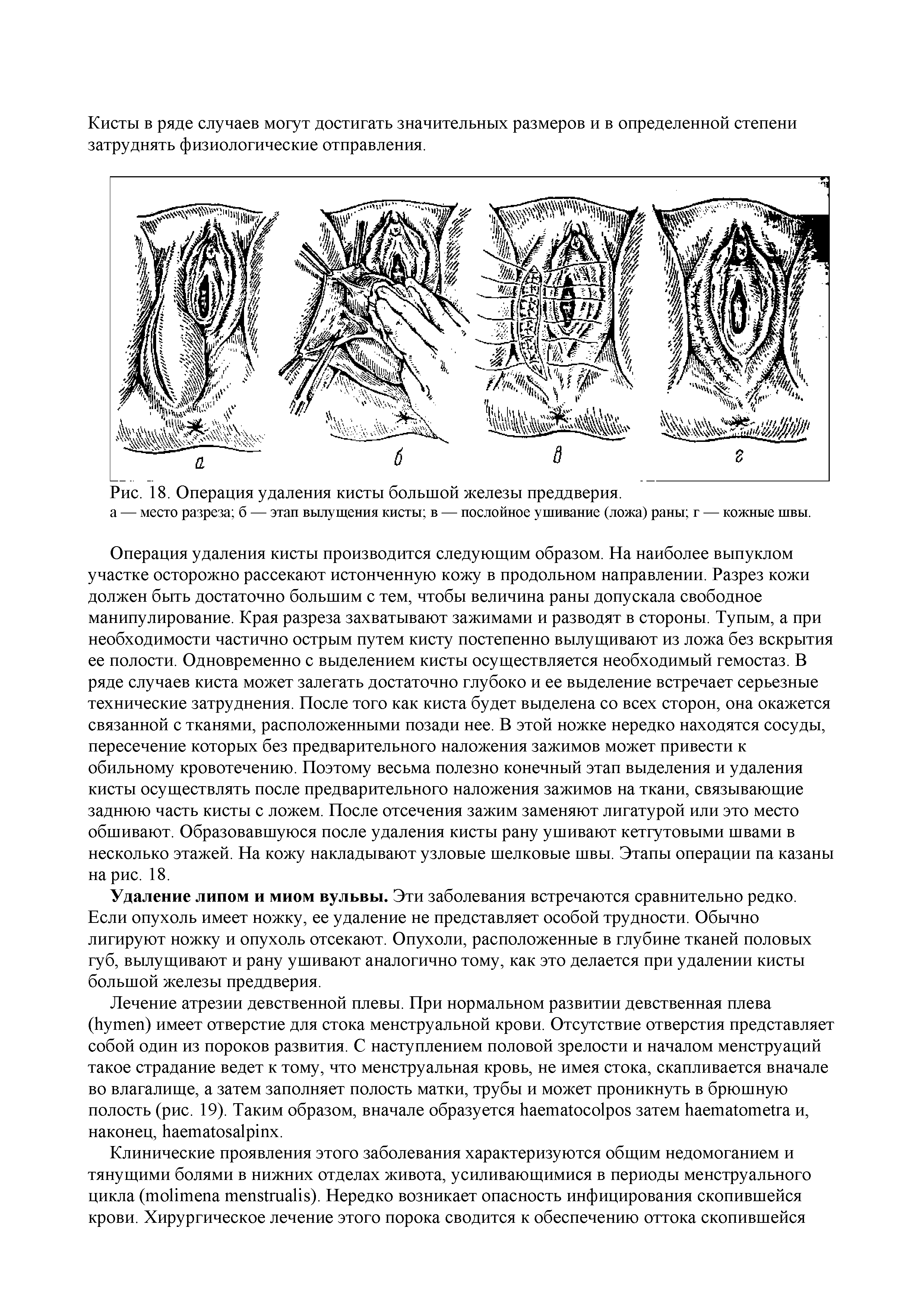 Рис. 18. Операция удаления кисты большой железы преддверия.