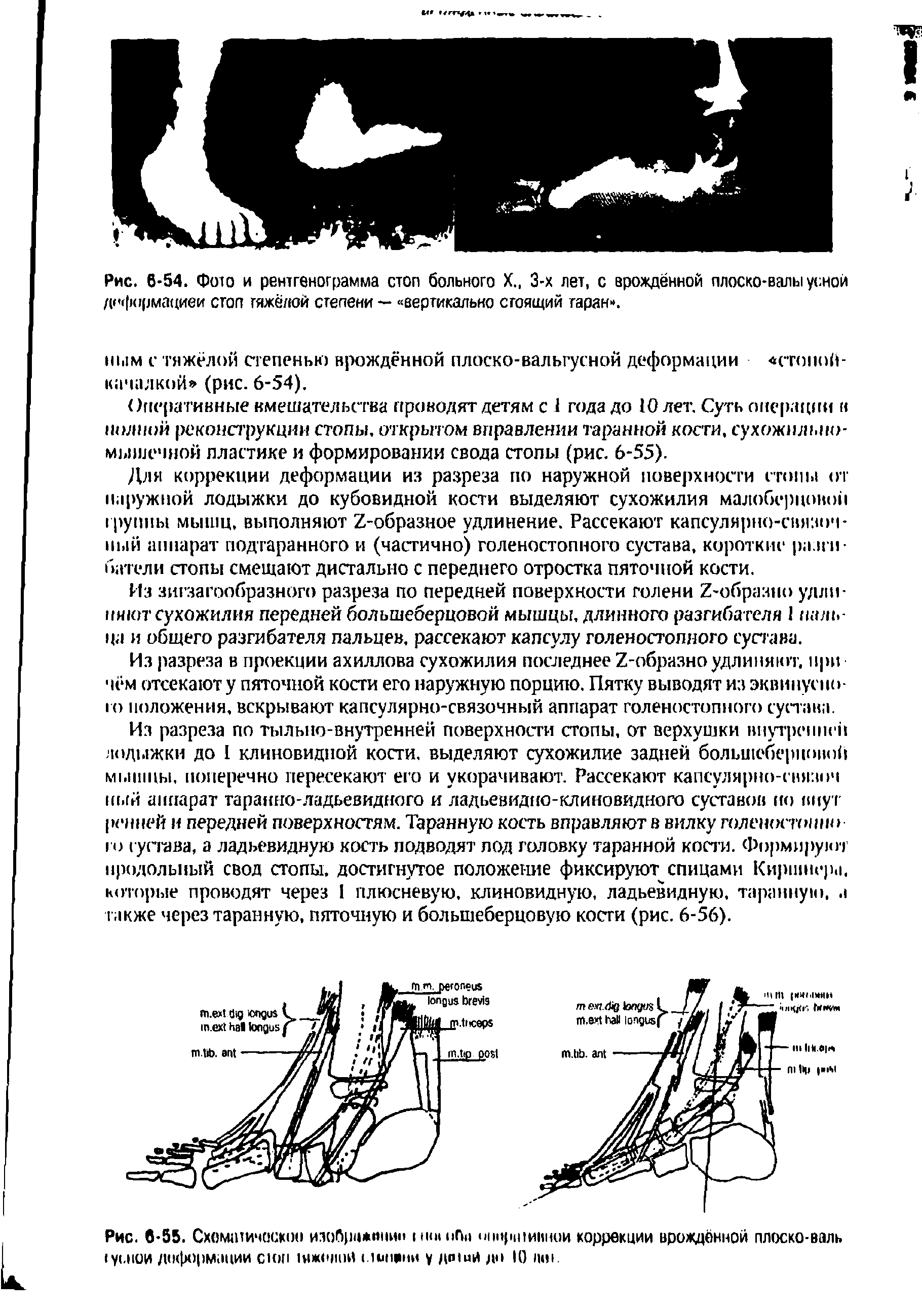 Рис. 6-54. Фшо и рентгенограмма стоп больного X., 3-х лет, с врождённой плоско-валы усной деформацией стоп тяжёлой степени — вертикально стоящий таран .