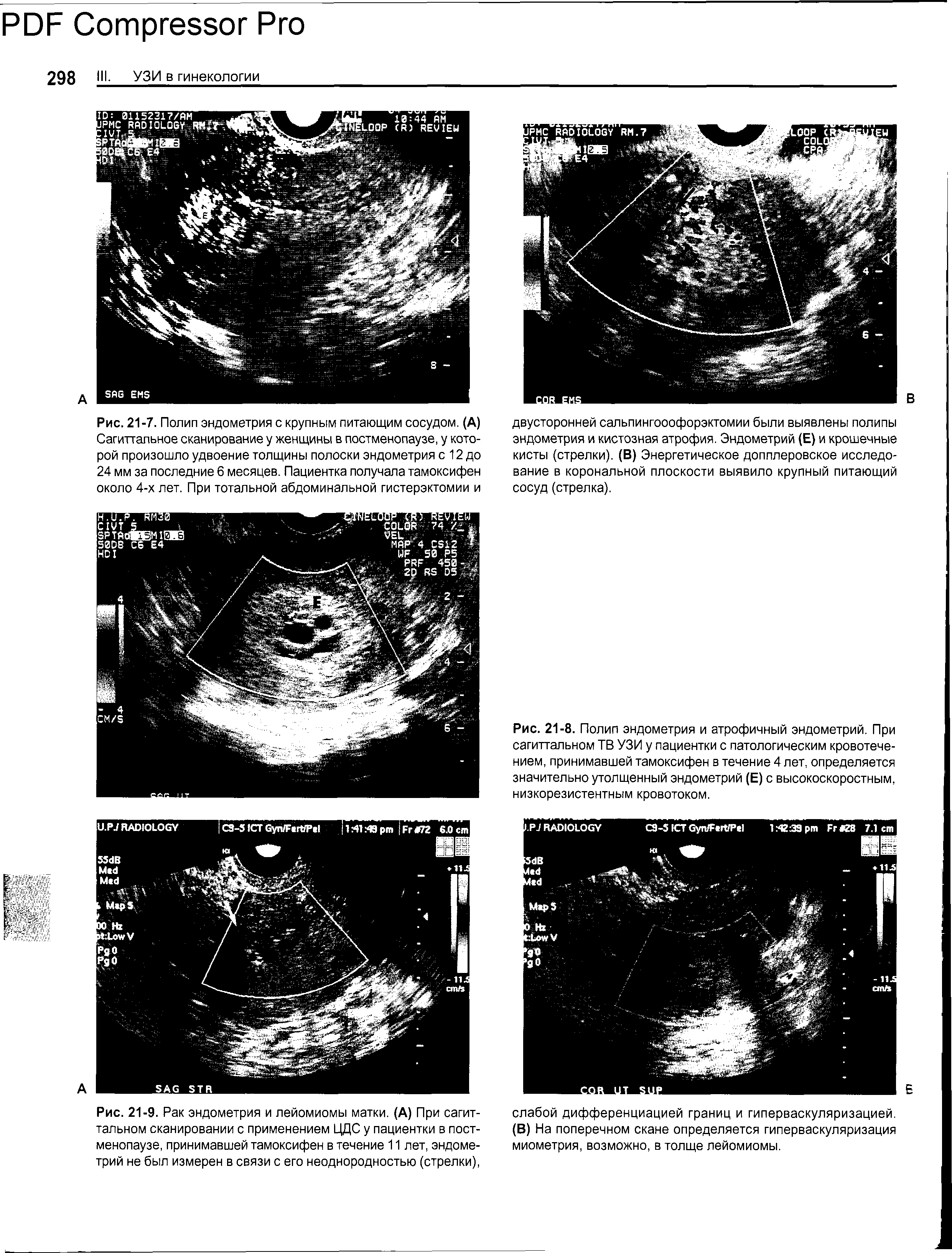 Рис. 21-9. Рак эндометрия и лейомиомы матки. (А) При сагиттальном сканировании с применением ЦДС у пациентки в постменопаузе, принимавшей тамоксифен в течение 11 лет, эндометрий не был измерен в связи с его неоднородностью (стрелки),...