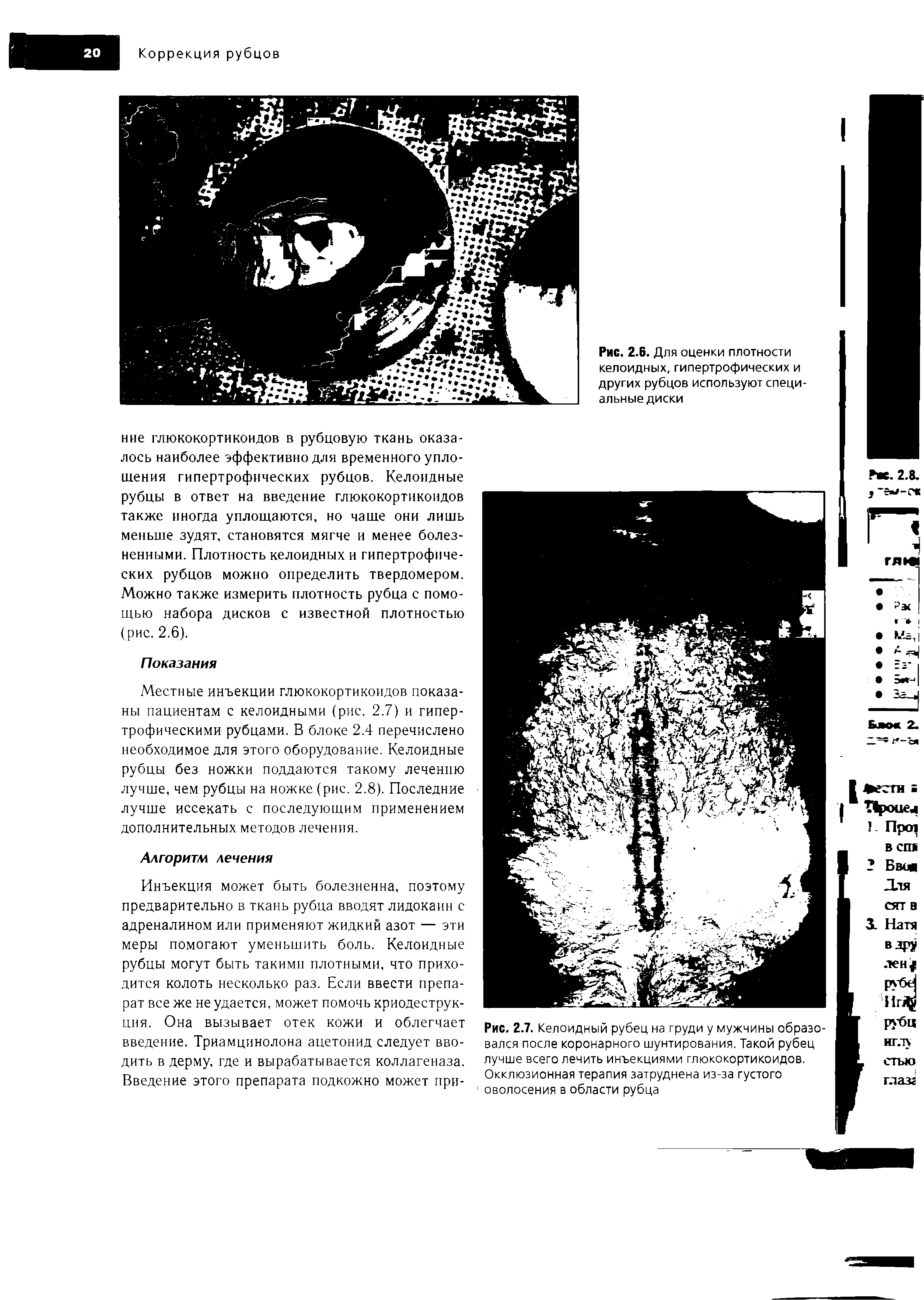 Рис. 2.7. Келоидный рубец на груди у мужчины образовался после коронарного шунтирования. Такой рубец лучше всего лечить инъекциями глюкокортикоидов. Окклюзионная терапия затруднена из-за густого оволосения в области рубца...