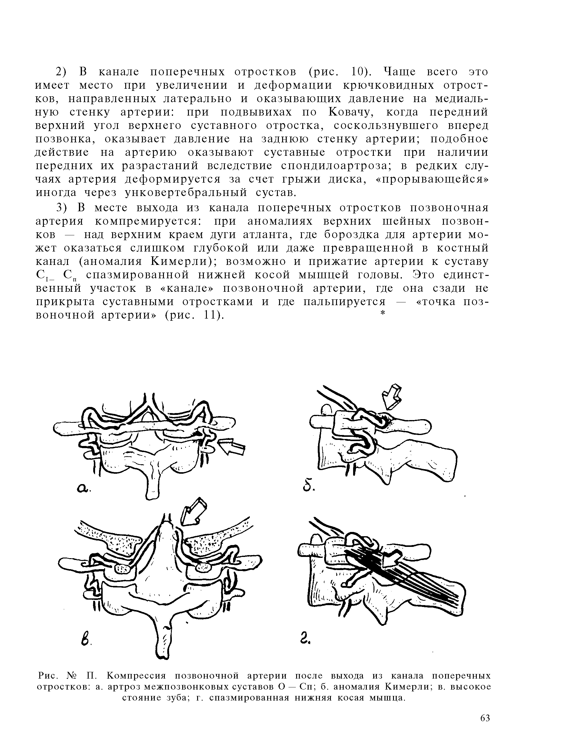 Рис. № П. Компрессия позвоночной артерии после выхода из канала поперечных отростков а. артроз межпозвонковых суставов О —Сп б. аномалия Кимерли в. высокое стояние зуба г. спазмированная нижняя косая мышца.
