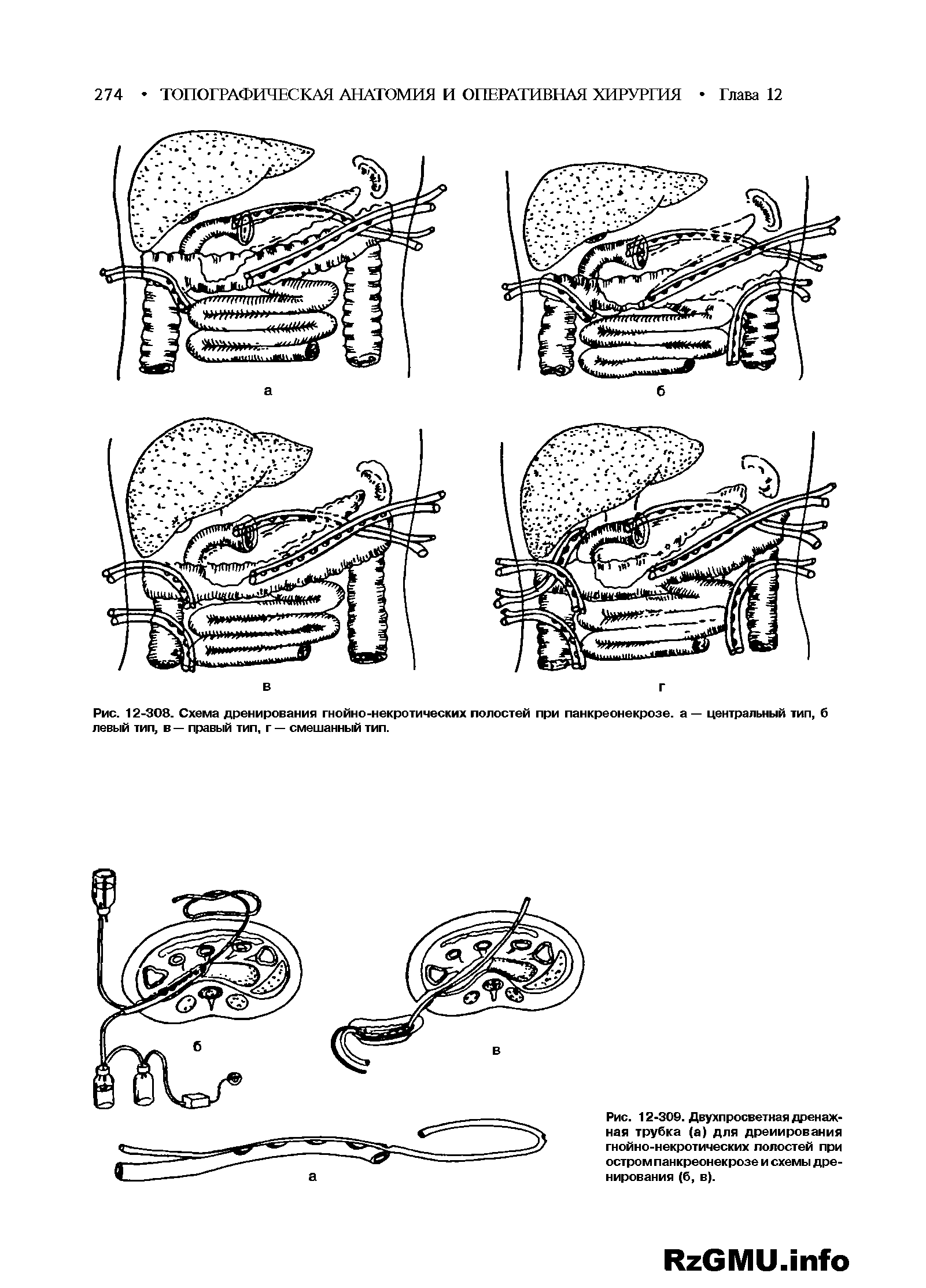 Рис. 12-308. Схема дренирования гнойно-некротических полостей при панкреонекрозе. а — центральный тип, б левый тип, в — правый тип, г — смешанный тип.