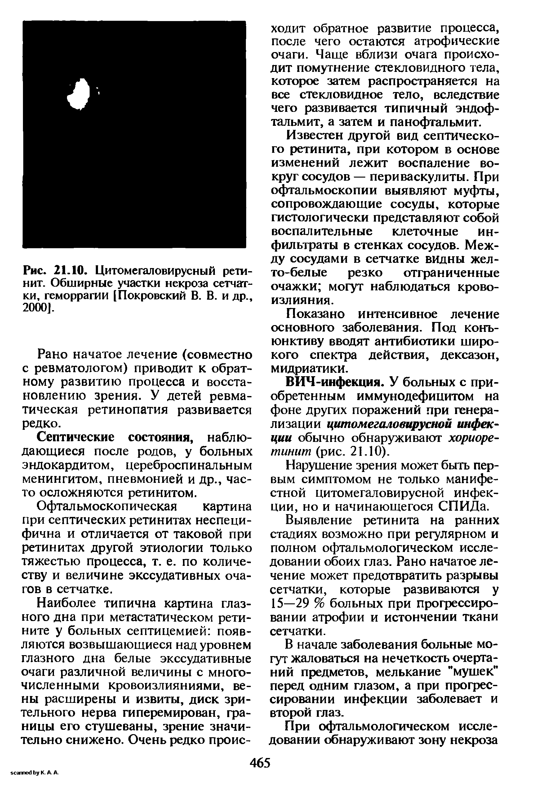 Рис. 21.10. Цитомегаловирусный ретинит. Обширные участки некроза сетчатки, геморрагии [Покровский В. В. и др., 2000].