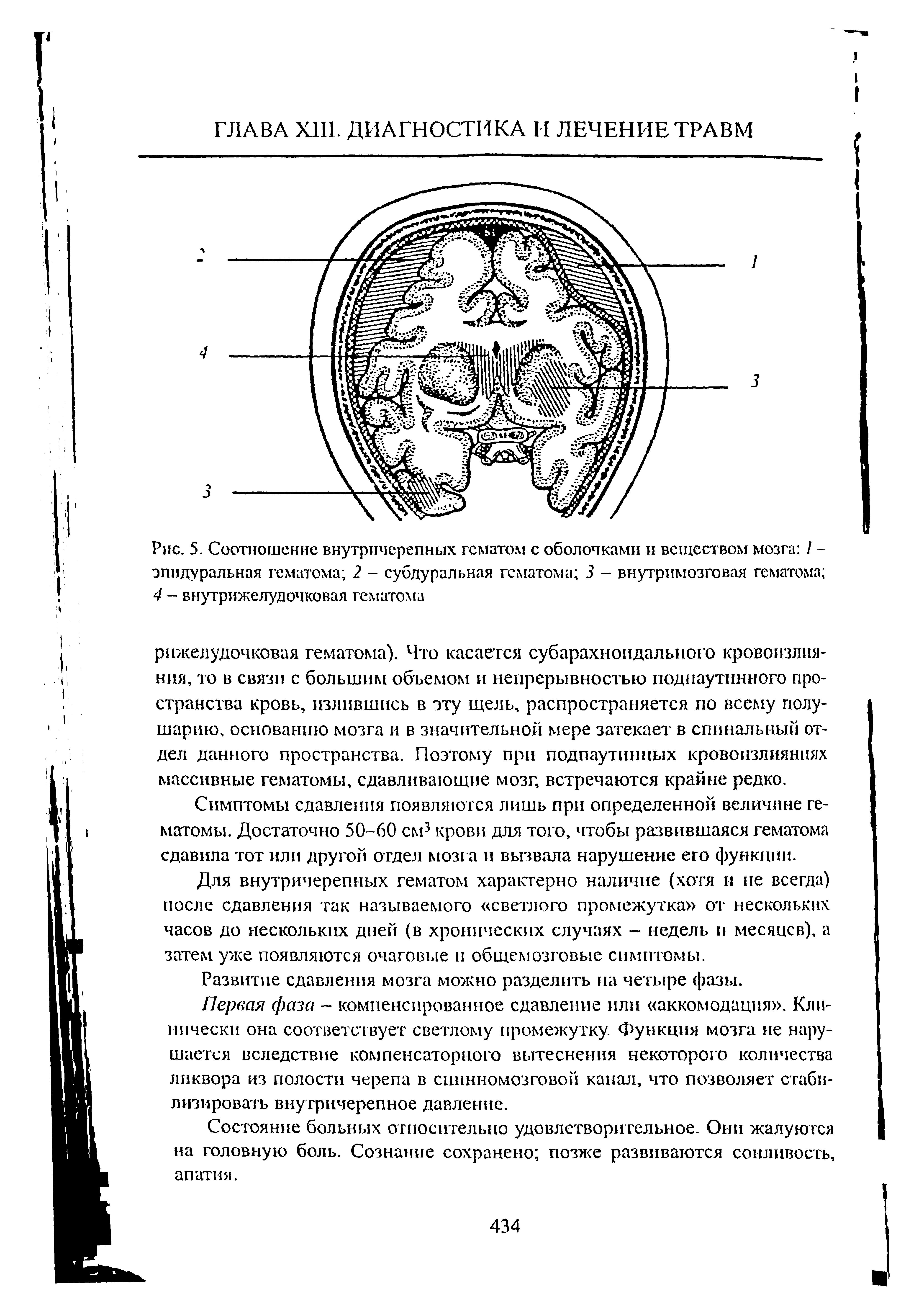 Рис. 5. Соотношение внутричерепных гематом с оболочками и веществом мозга / -эпидуральная гематома 2 - субдуральная гематома 3 - внутримозговая гематома 4 - внутрижелудочковая гематома...