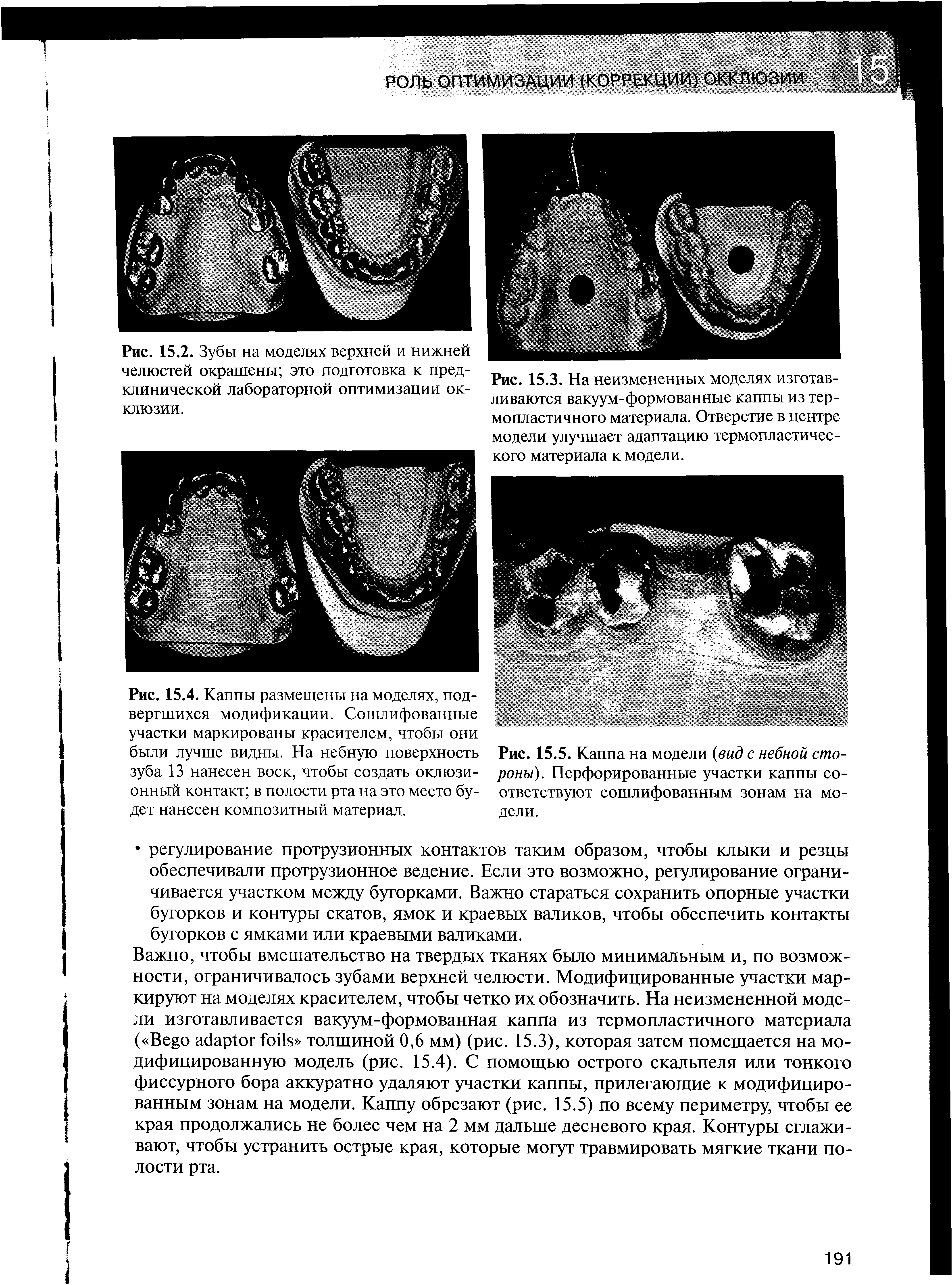 Рис. 15.5. Каппа на модели (вид с небной стороны). Перфорированные участки каппы соответствуют сошлифованным зонам на модели.