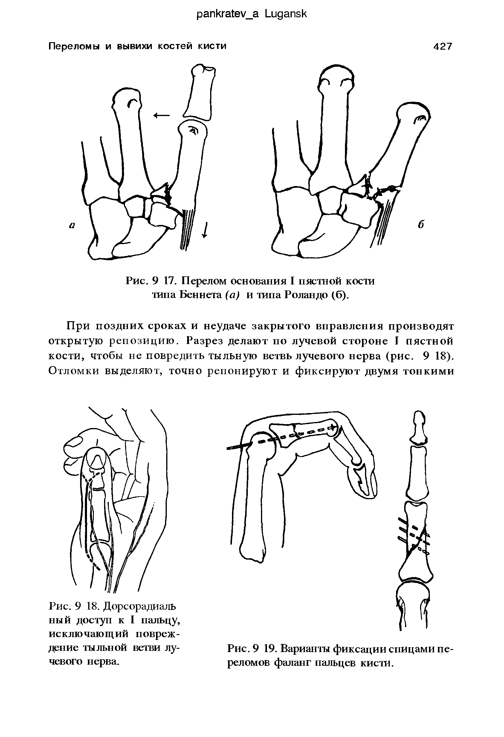 Рис. 9 19. Варианты фиксации спицами переломов фаланг пальцев кисти.