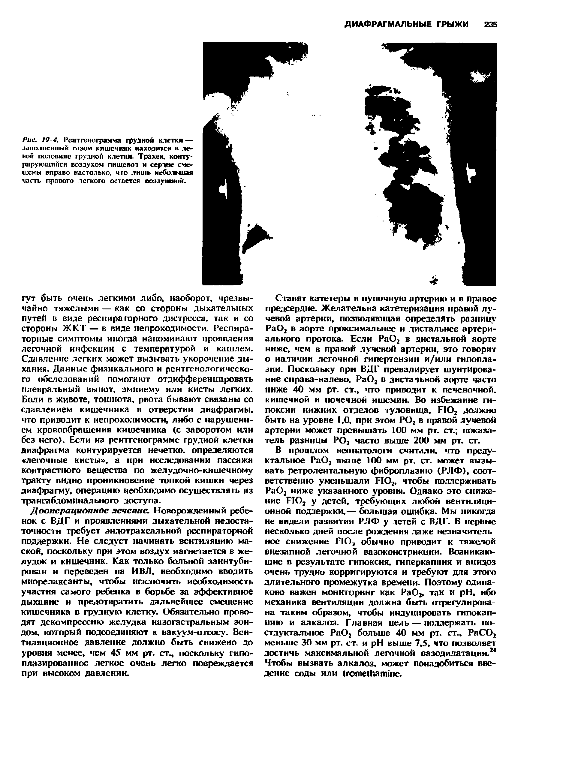 Рис. 19-4. Рентгенограмма грузной клетки — з.1 1о.1пеипый газом кишечник находится в ле-ноГ( полошшс грудной клетки. Трахея, конту-рирующийся воздухом пищевод и серпке смещены вправо настолько, чго лишь небольшая часть правого легкого остается воздушной.