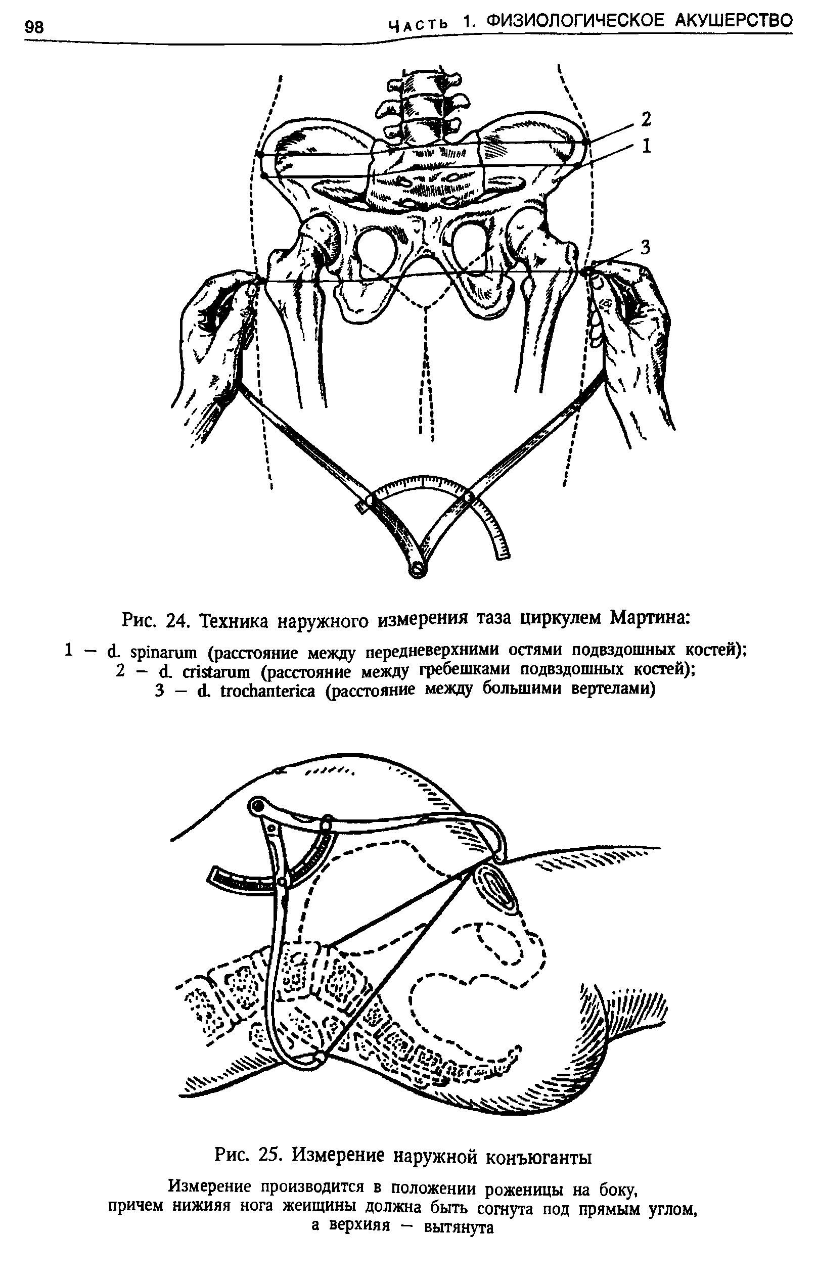 Рис. 24. Техника наружного измерения таза циркулем Мартина ...