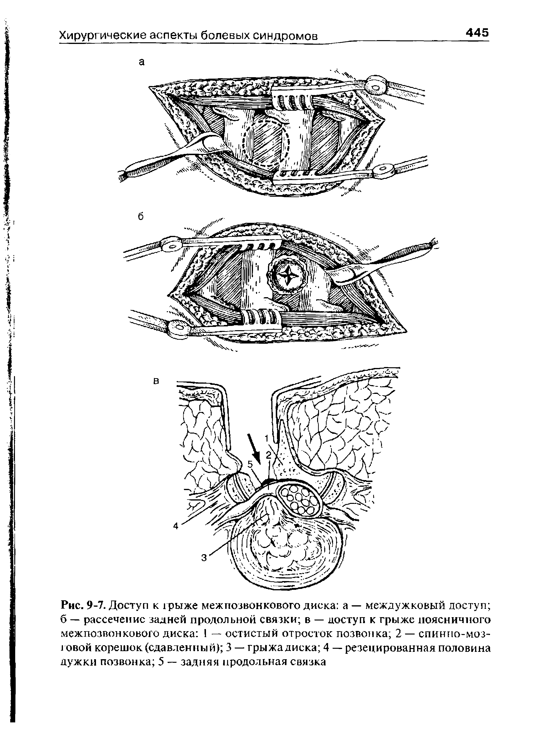 Рис. 9-7. Доступ к грыже межпозвонкового диска а — междужковый доступ б — рассечение задней продольной связки в — доступ к грыже поясничного межпозвонкового диска I —- остистый отросток позвонка 2 — спинно-мозговой корешок (сдавленный) 3 — грыжа диска 4 — резецированная половина дужки позвонка 5 — задняя продольная связка...