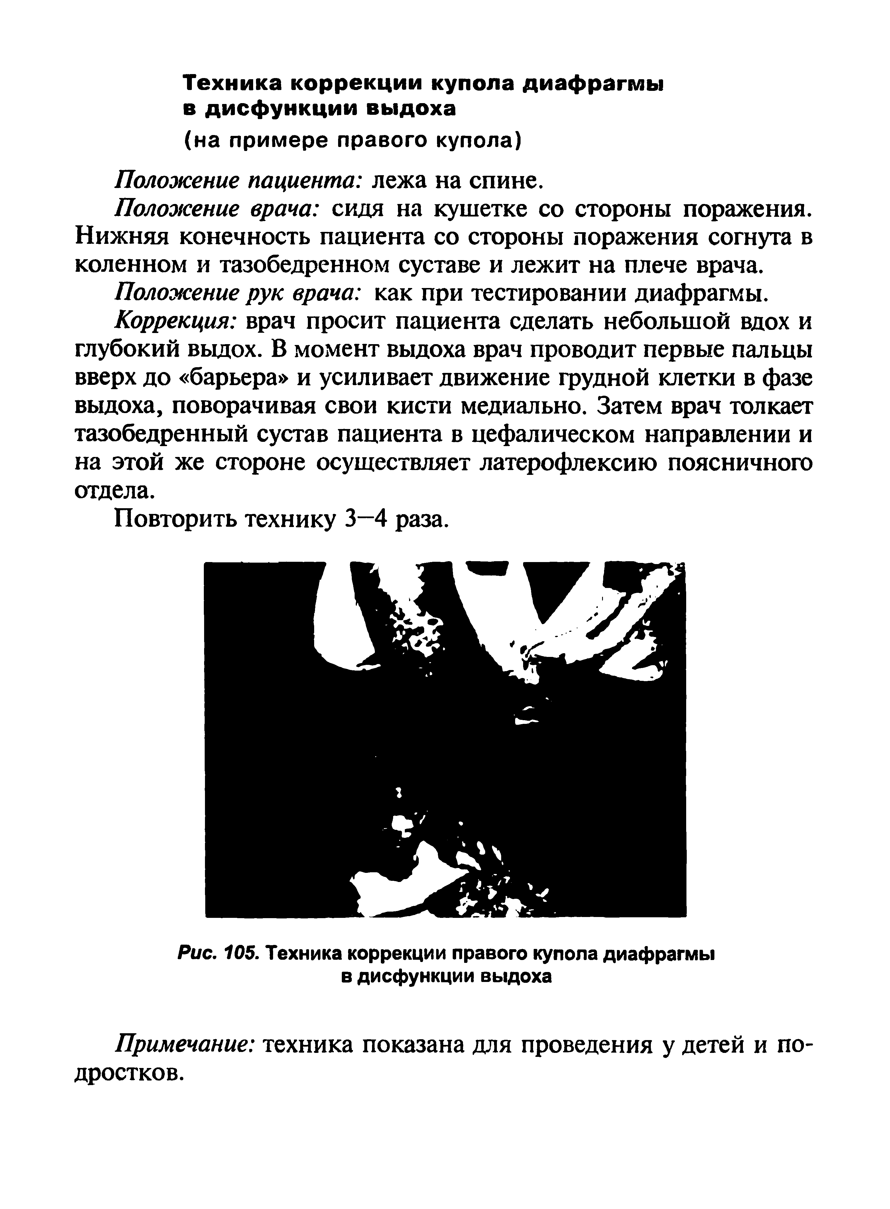 Рис. 105. Техника коррекции правого купола диафрагмы в дисфункции выдоха...