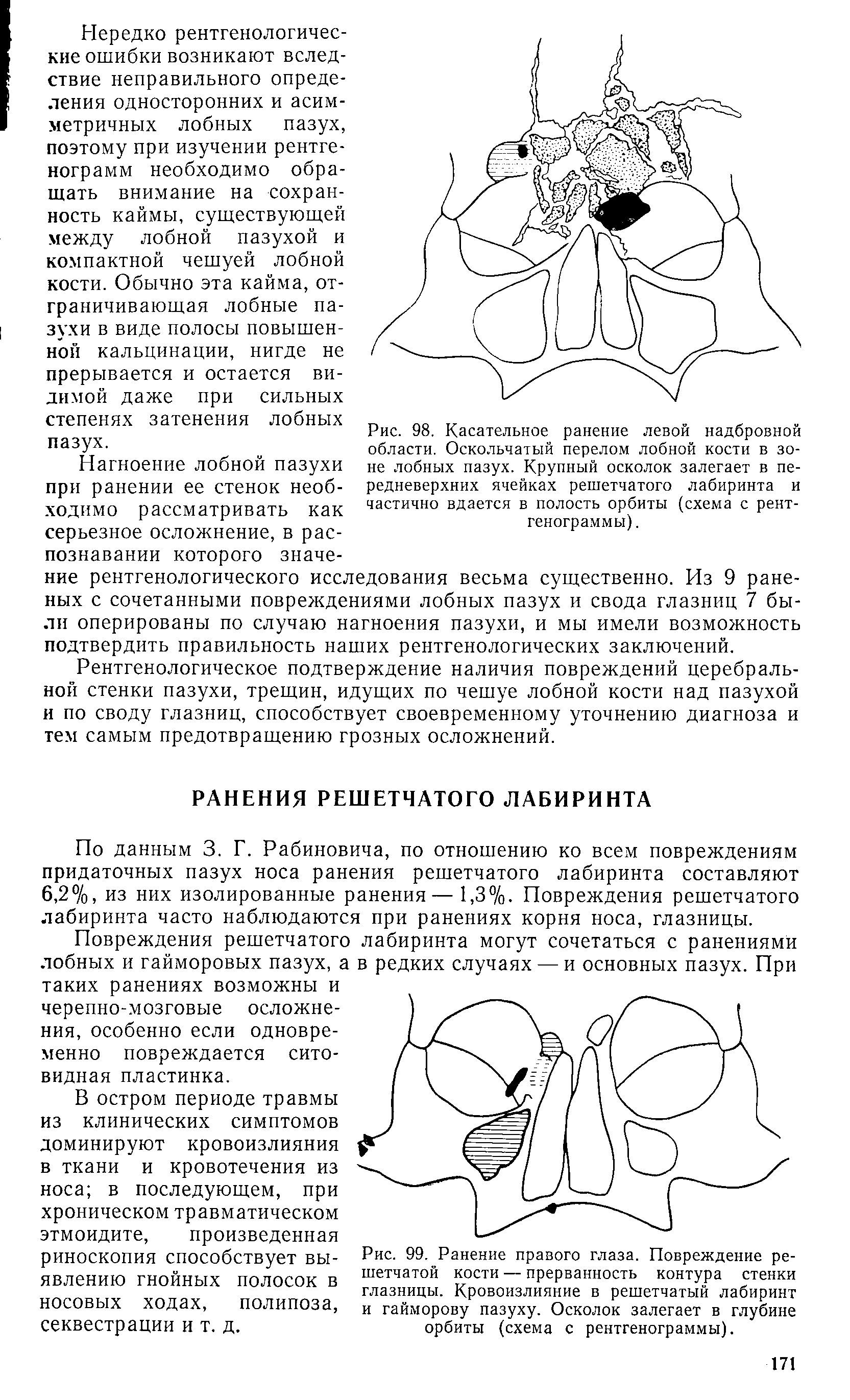 Рис. 99. Ранение правого глаза. Повреждение решетчатой кости — прерванность контура стенки глазницы. Кровоизлияние в решетчатый лабиринт и гайморову пазуху. Осколок залегает в глубине орбиты (схема с рентгенограммы).