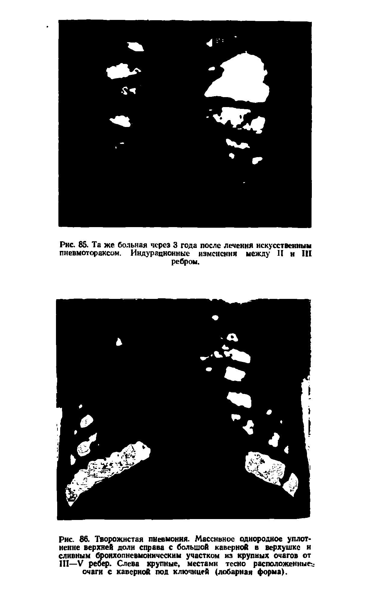Рис. 86. Творожистая пневмония. Массивное однородное уплотнение верхней доли справа с большой каверной в верхушке и сливным бронхопневмоническим участком из крупных очагов от III—V ребер. Слева крупные, местами тесно расположенные очаги с каверной под клю шцей (лобарная форма).