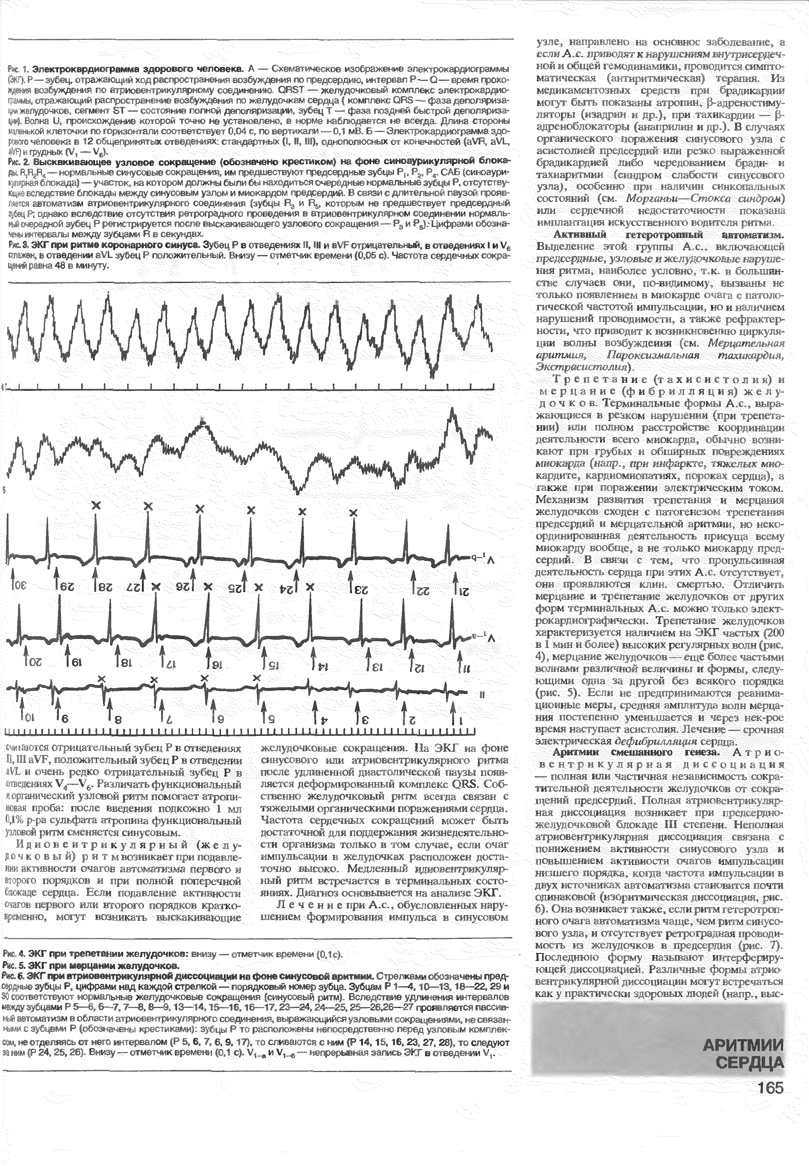 Рис. 2. Высквкиаающее узловое сокращение (обозначено крестиком, на фоне синоаурикулярной блокады. В,Н2Н4—нормальные синусовые сокращения, им предшествуют предсерд - Б (синоаури-...